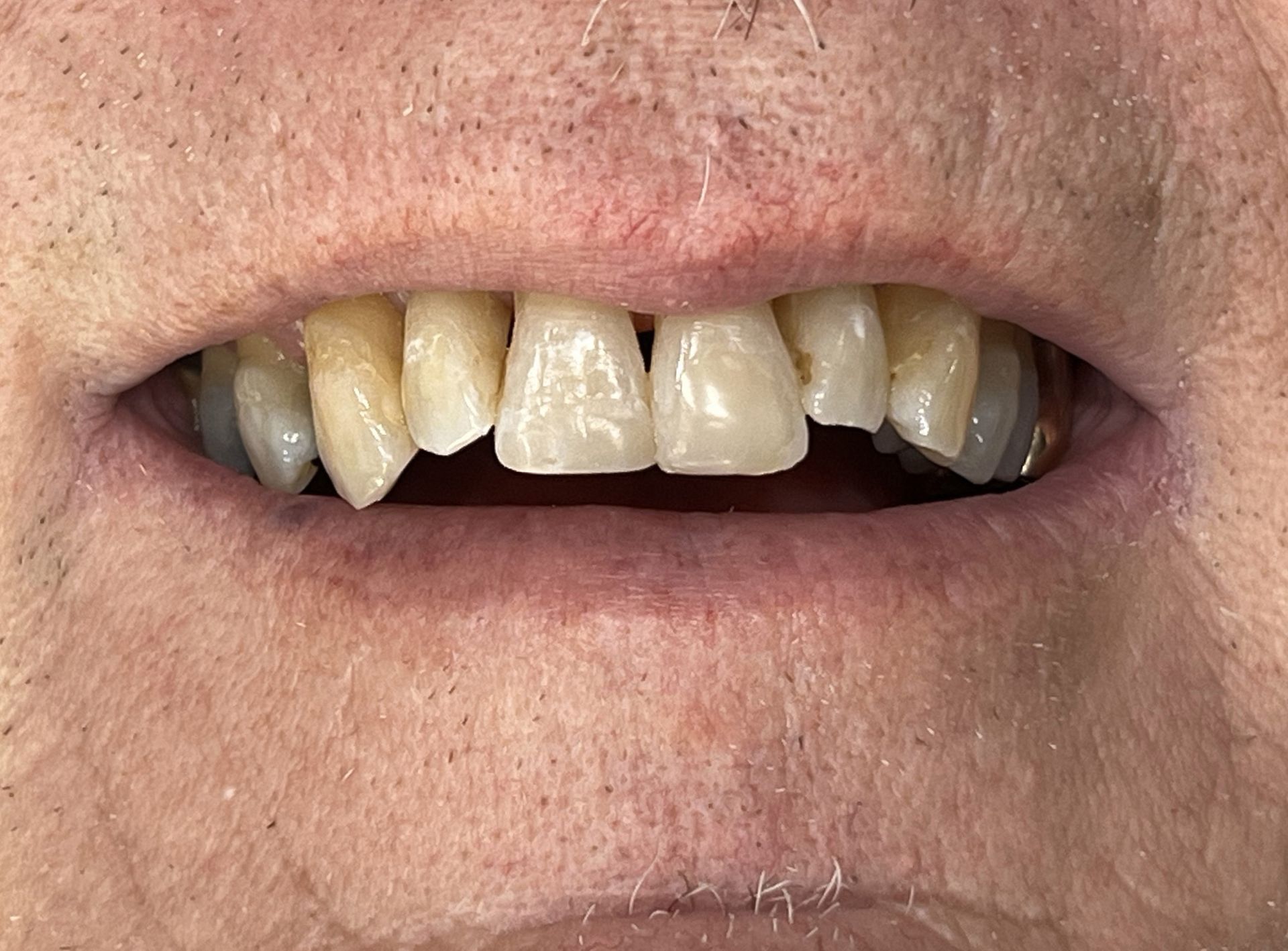 A close up of a man 's mouth showing his teeth.