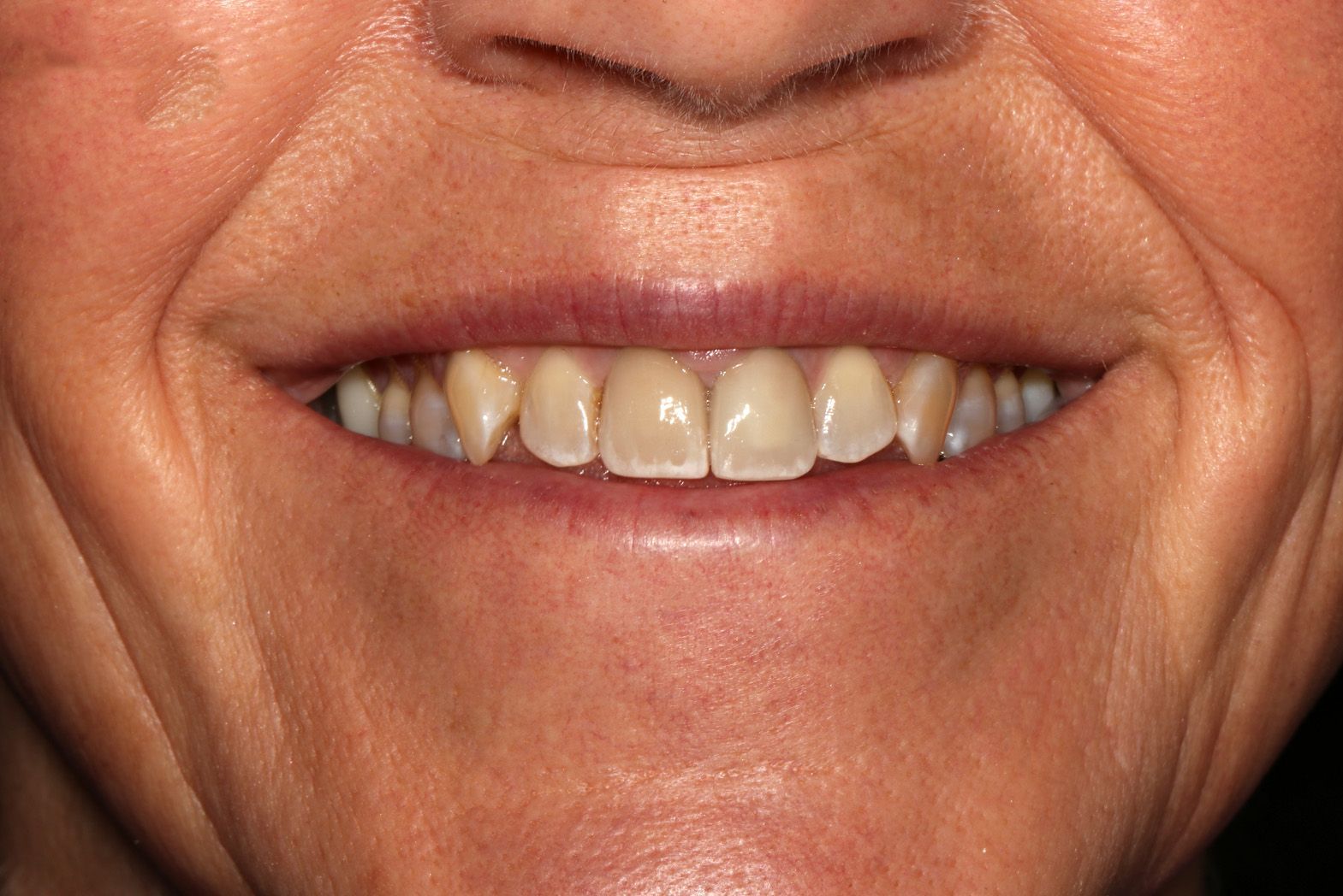 A close up of a woman 's mouth with white teeth and wrinkles.