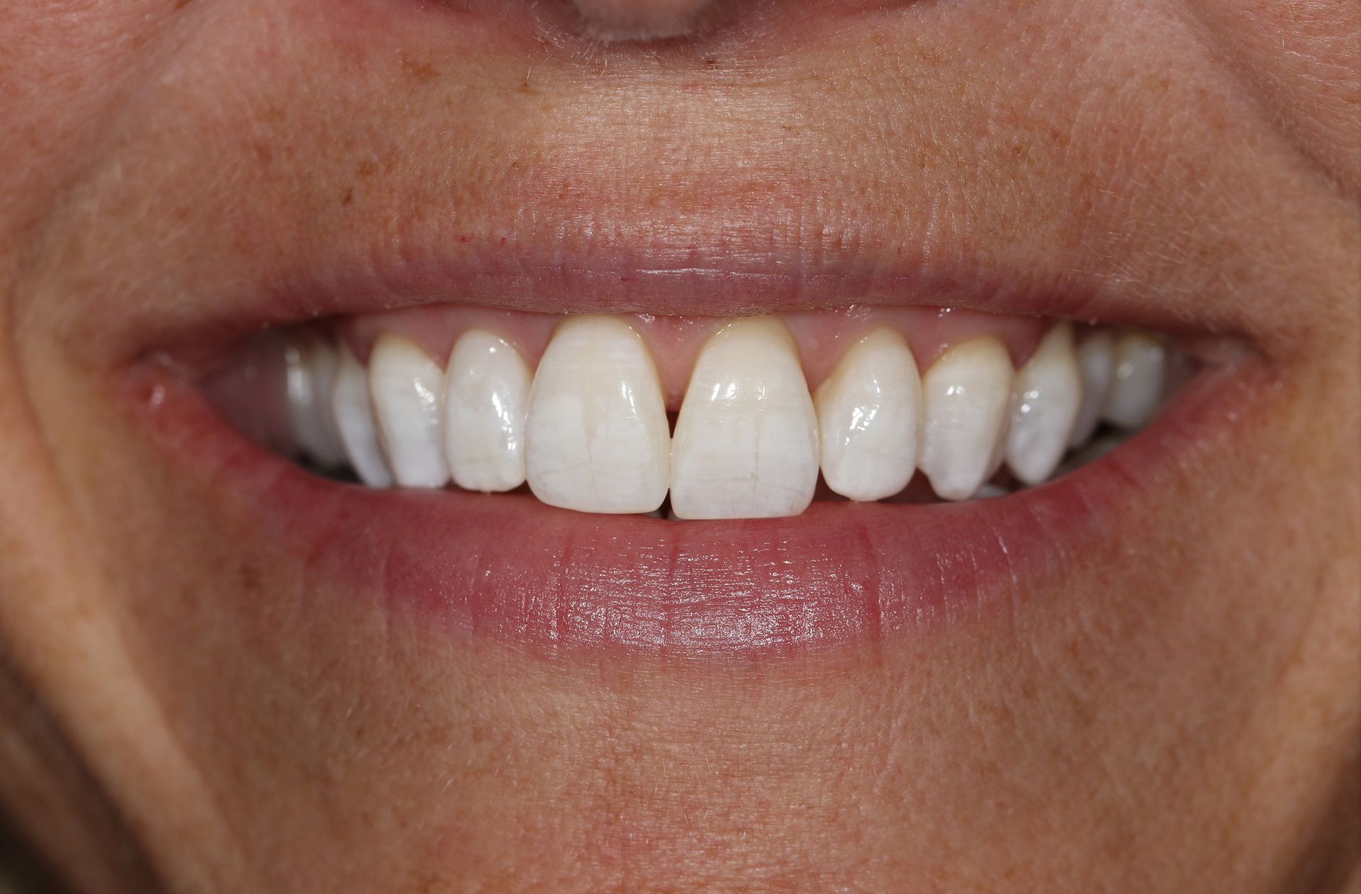 A close up of a woman 's smile with white teeth.