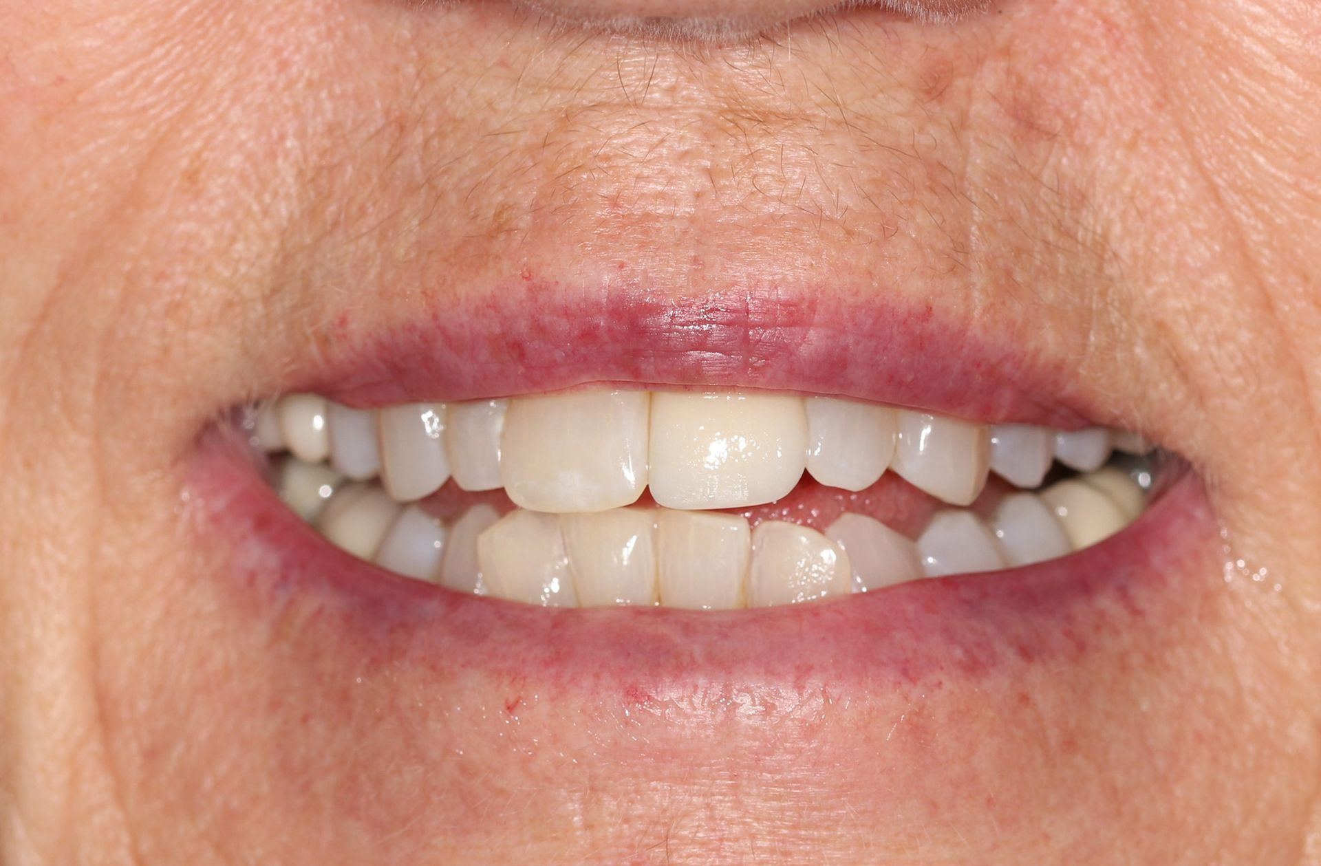 A close up of an older woman 's smile with white teeth.
