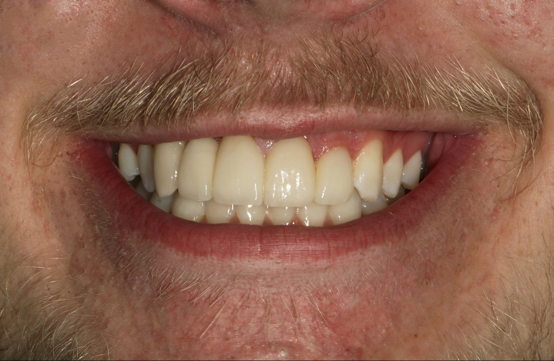 A close up of a man 's mouth with a beard and white teeth.