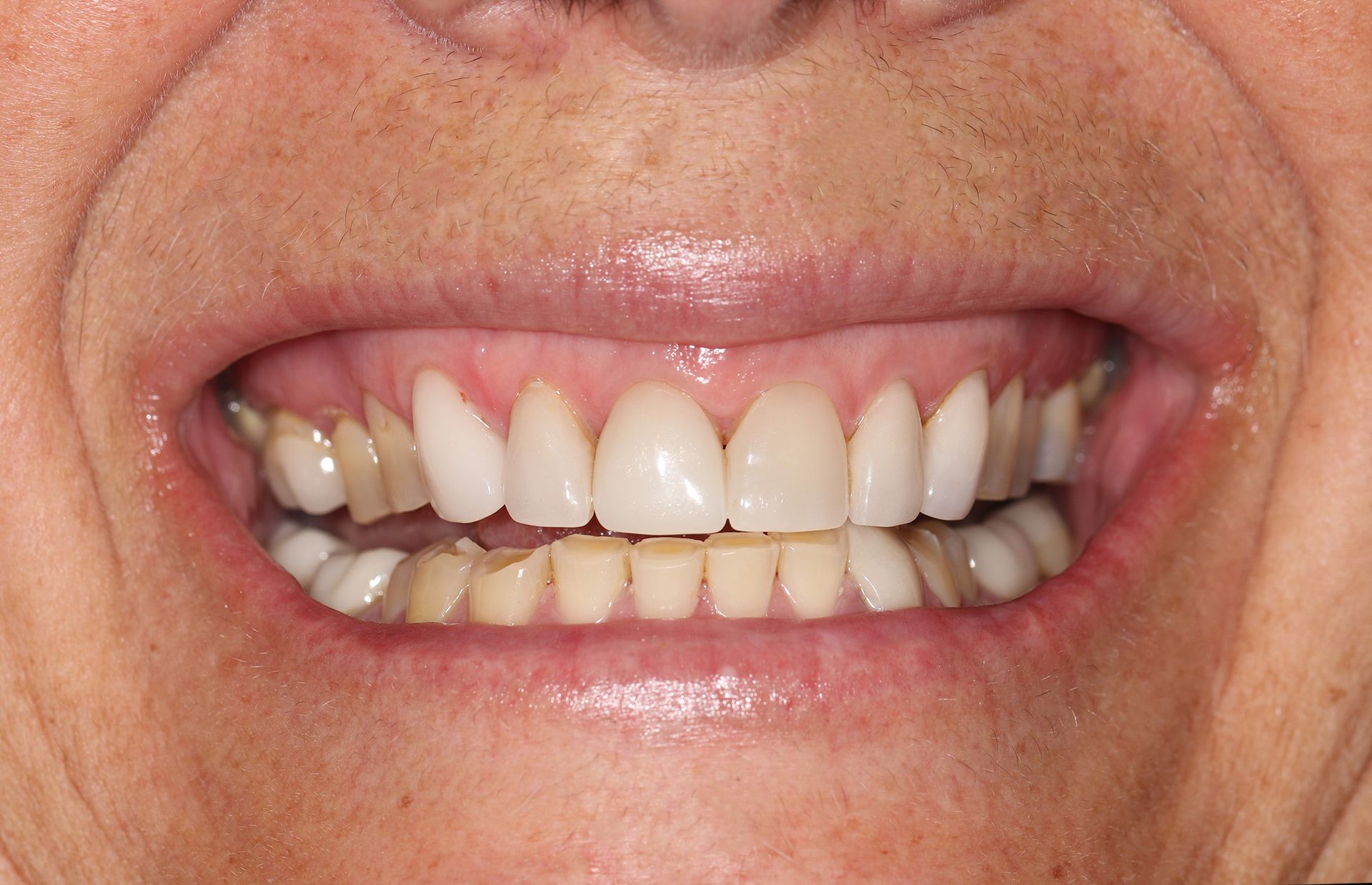 A close up of a person 's mouth with white teeth.