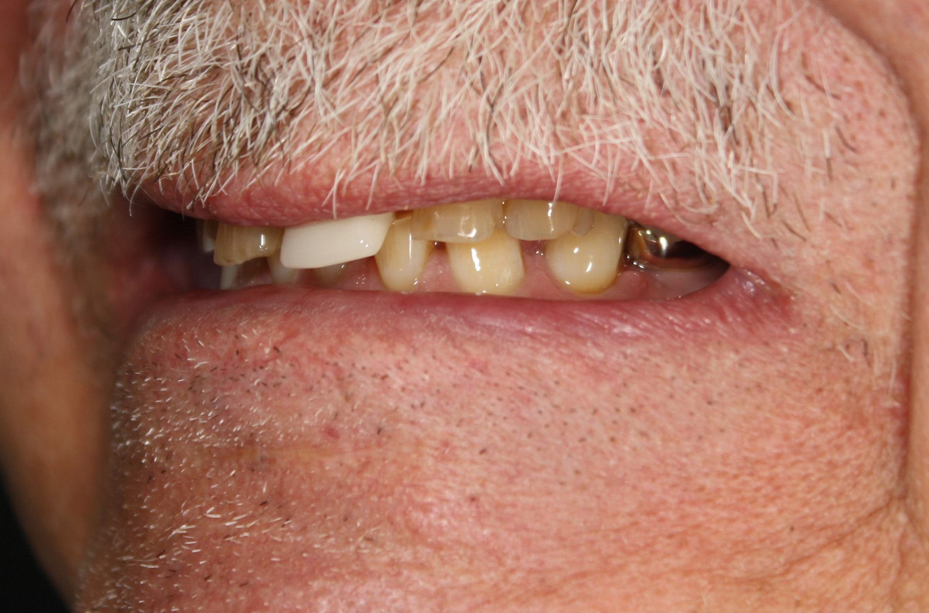 A close up of a man 's mouth with missing teeth and a beard.