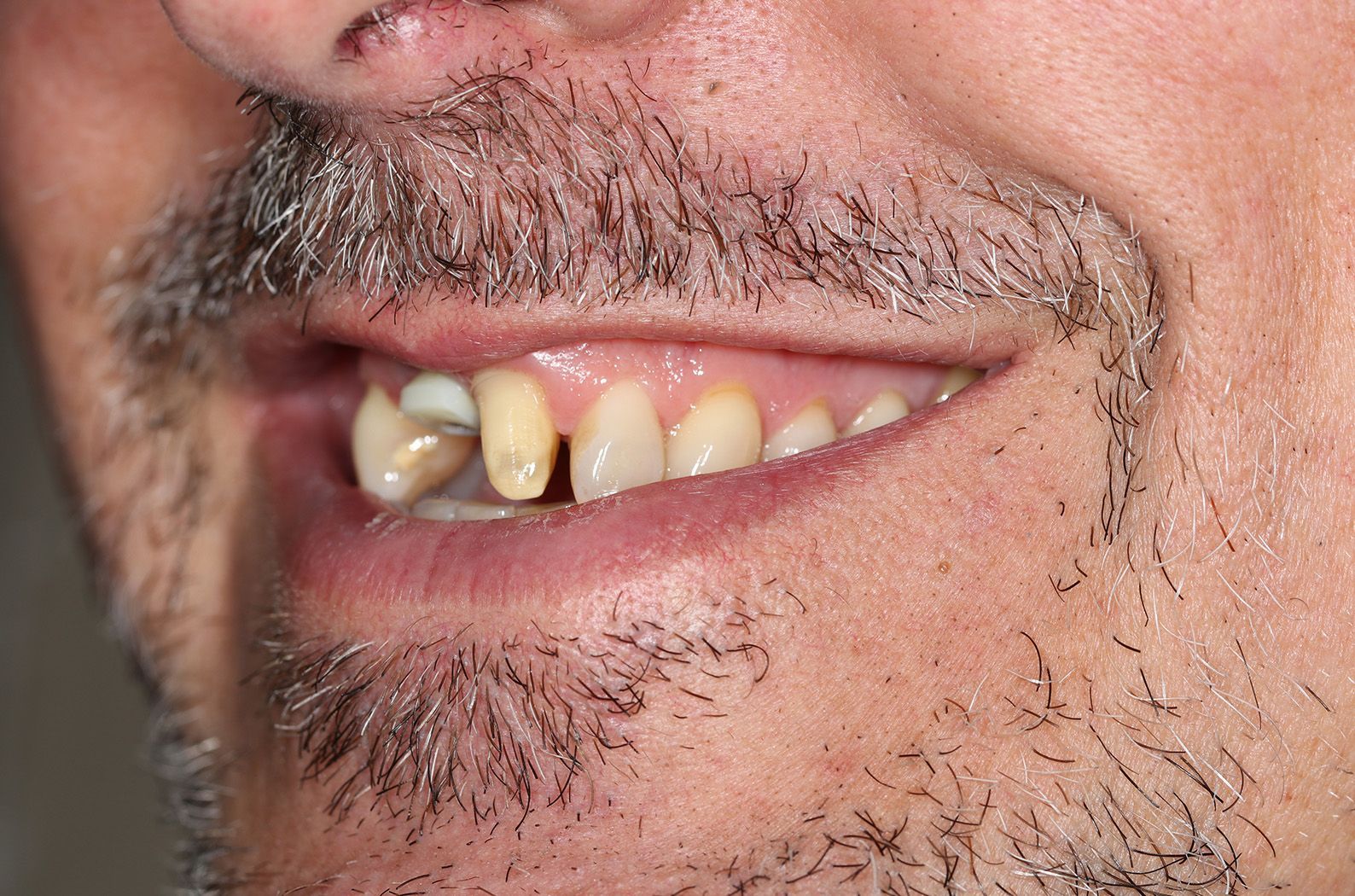 A man with a beard and missing teeth is smiling.
