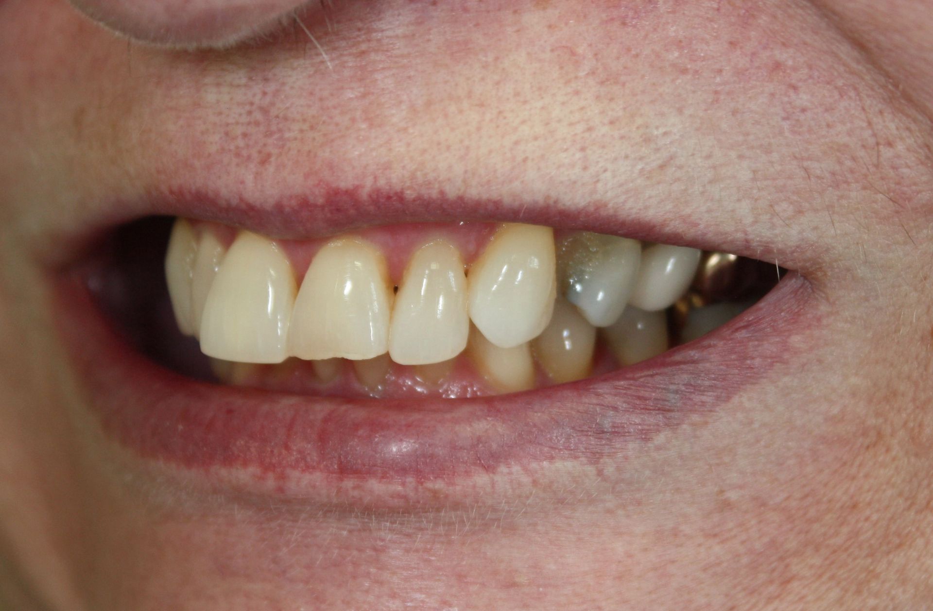 A close up of a person 's mouth with their teeth showing.
