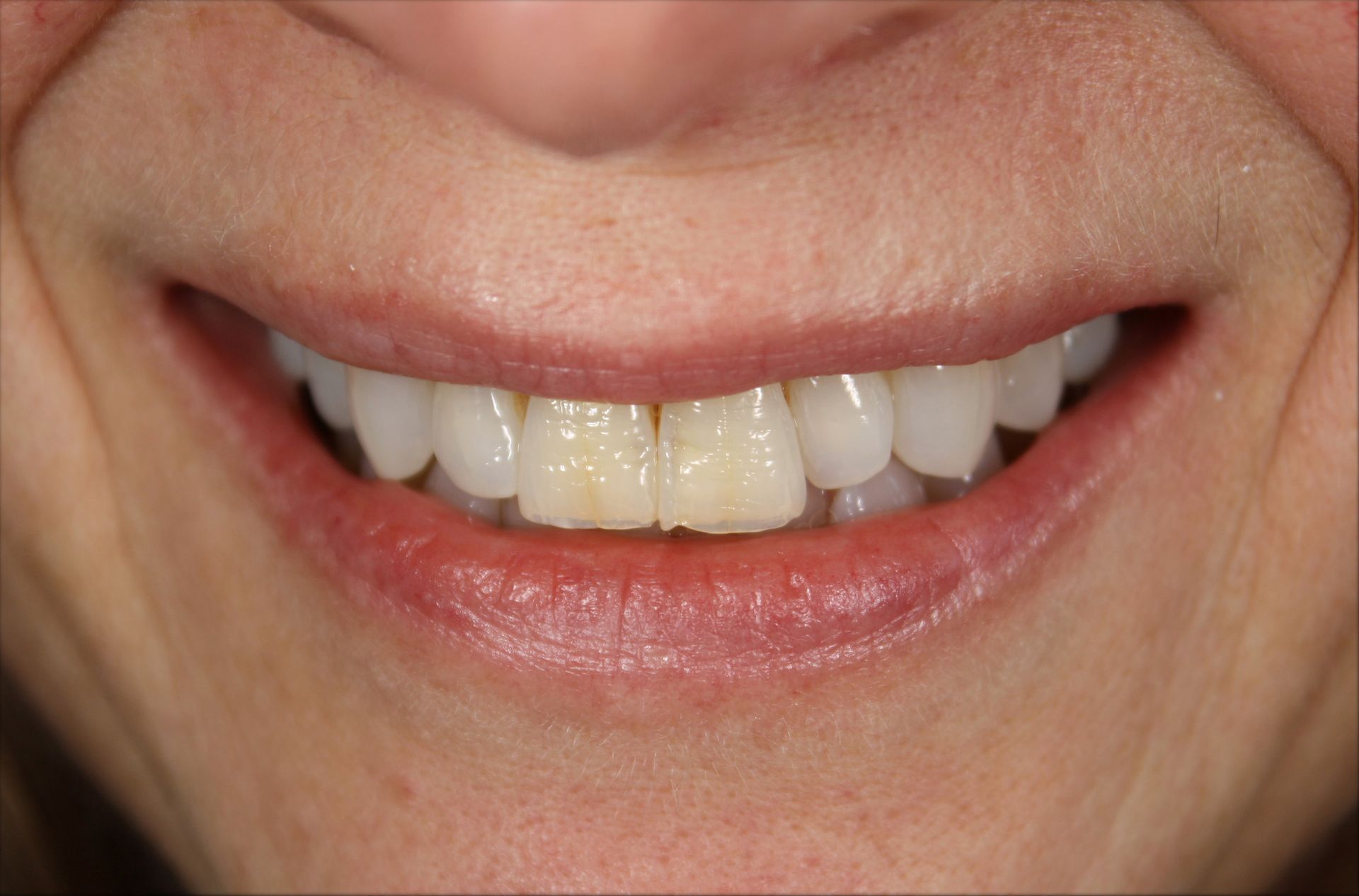 A close up of a woman 's smile with white teeth.
