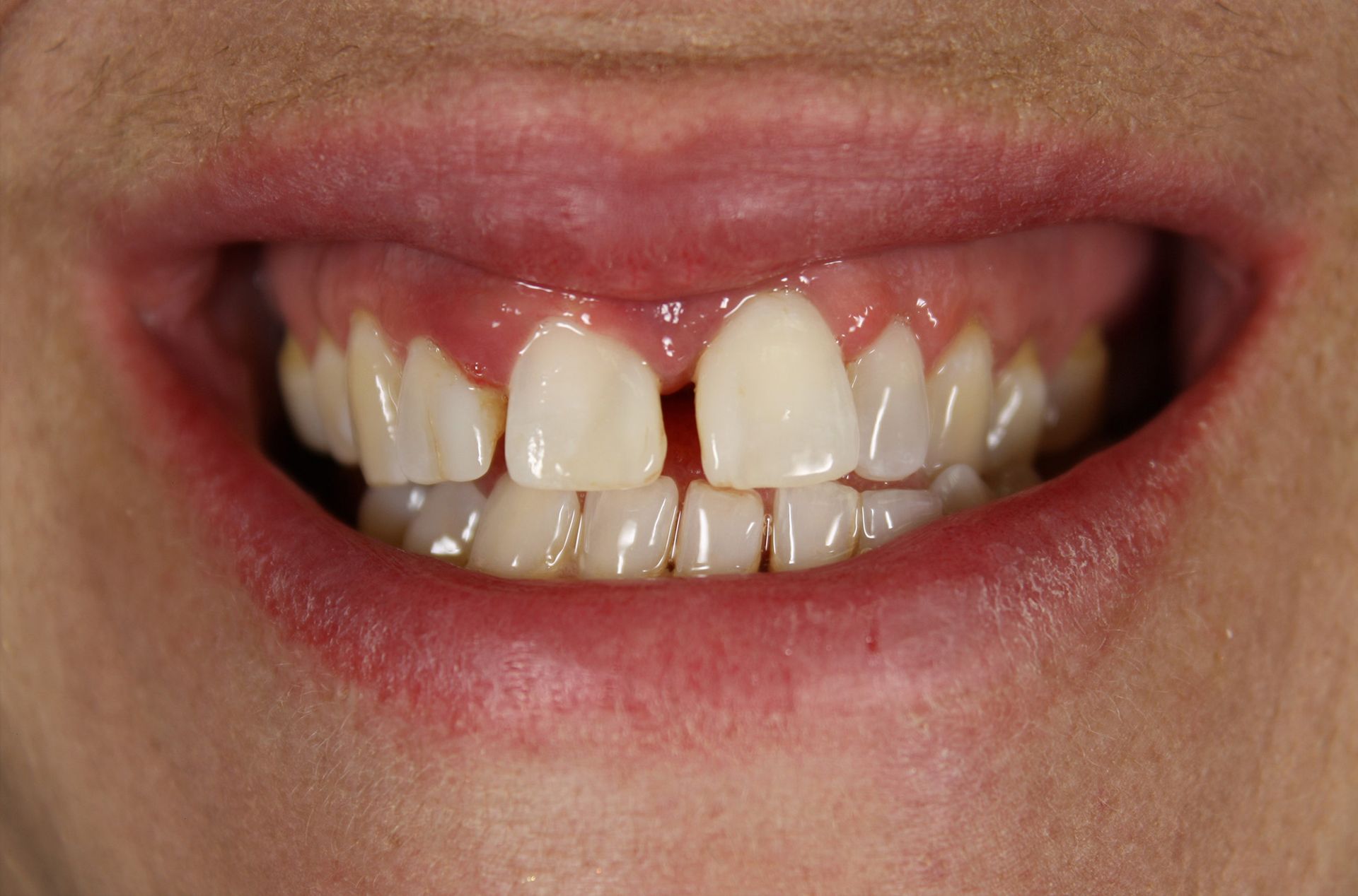 A close up of a person 's teeth with a missing tooth.