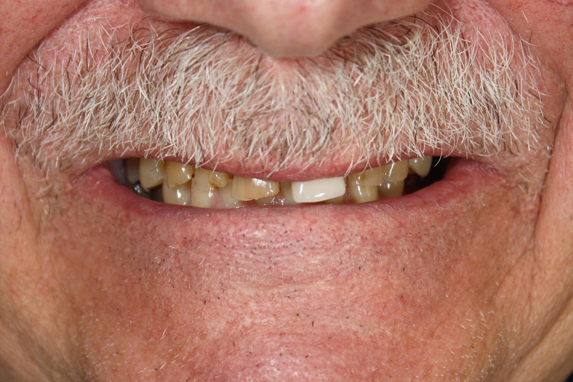 A close up of a man 's mouth with a beard and missing teeth.