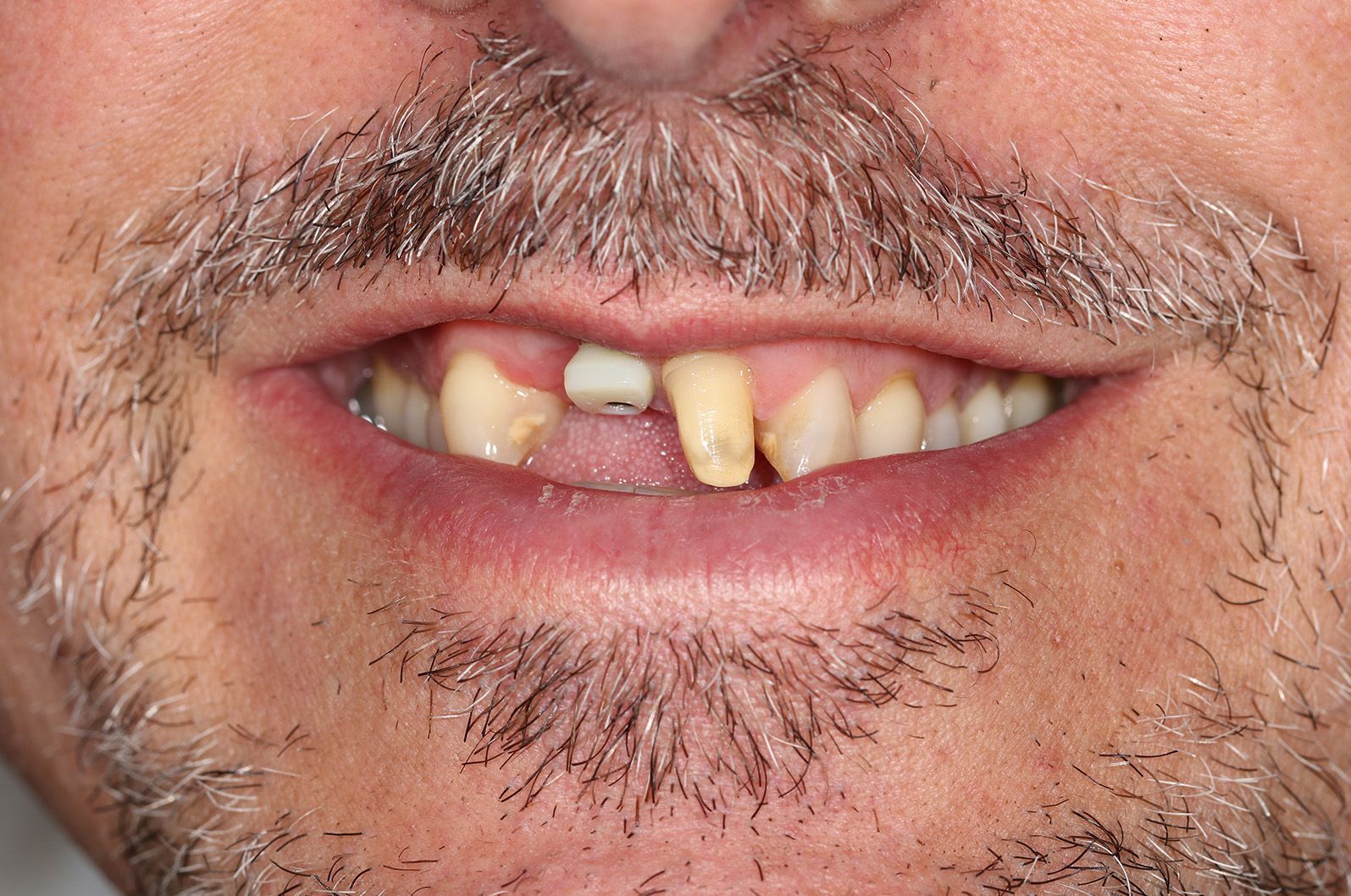 A close up of a man 's mouth with a beard and missing teeth.