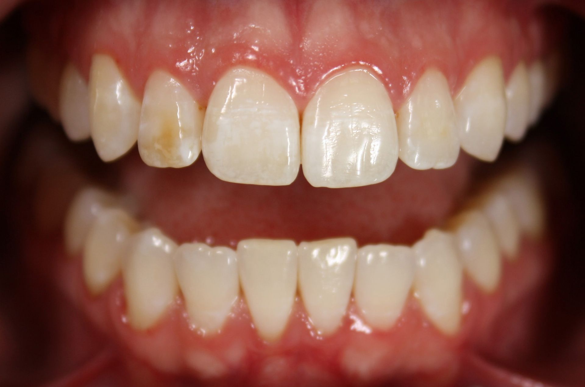 A close up of a person 's teeth with white teeth.