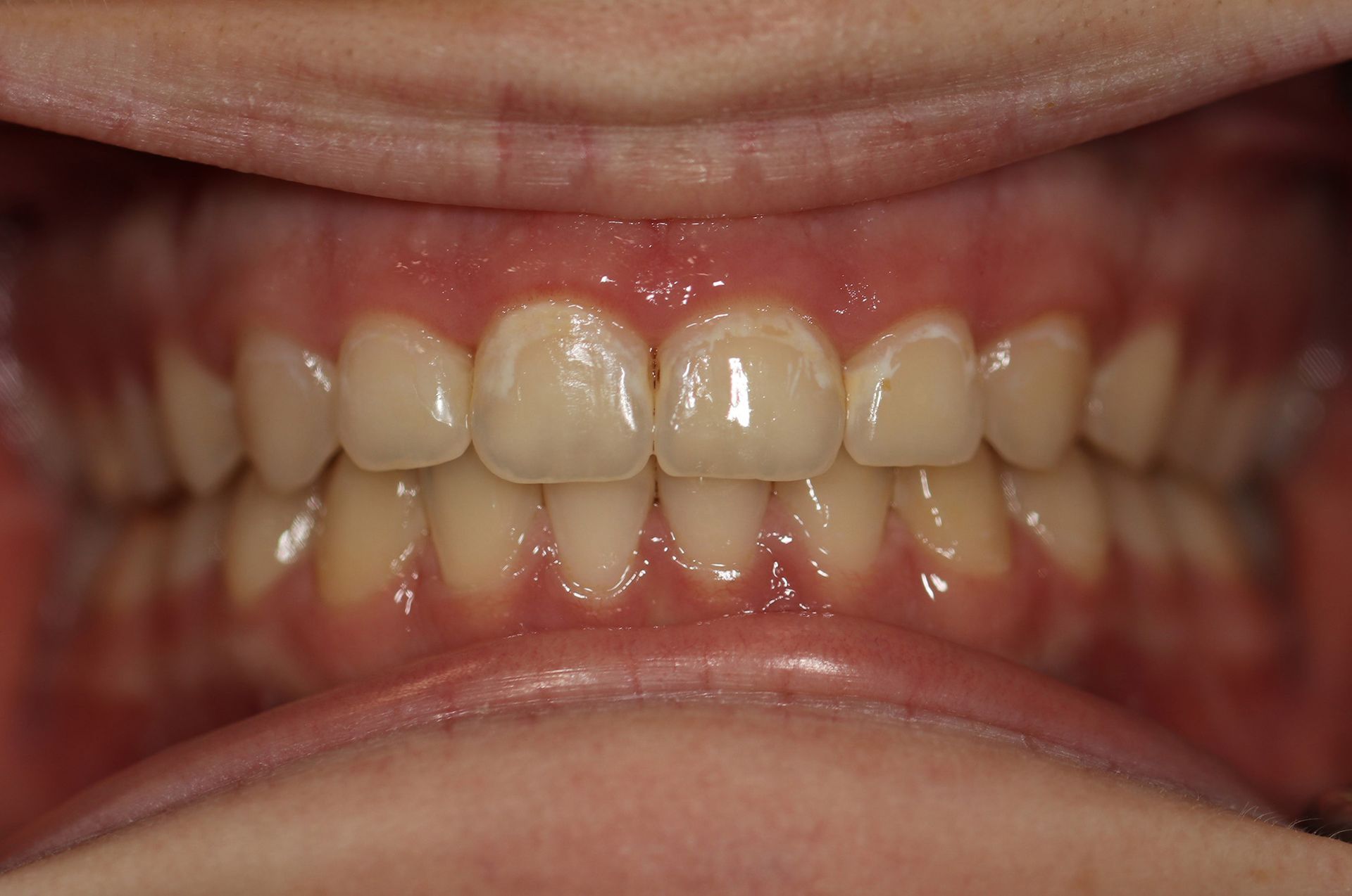 A close up of a person 's teeth with white teeth.