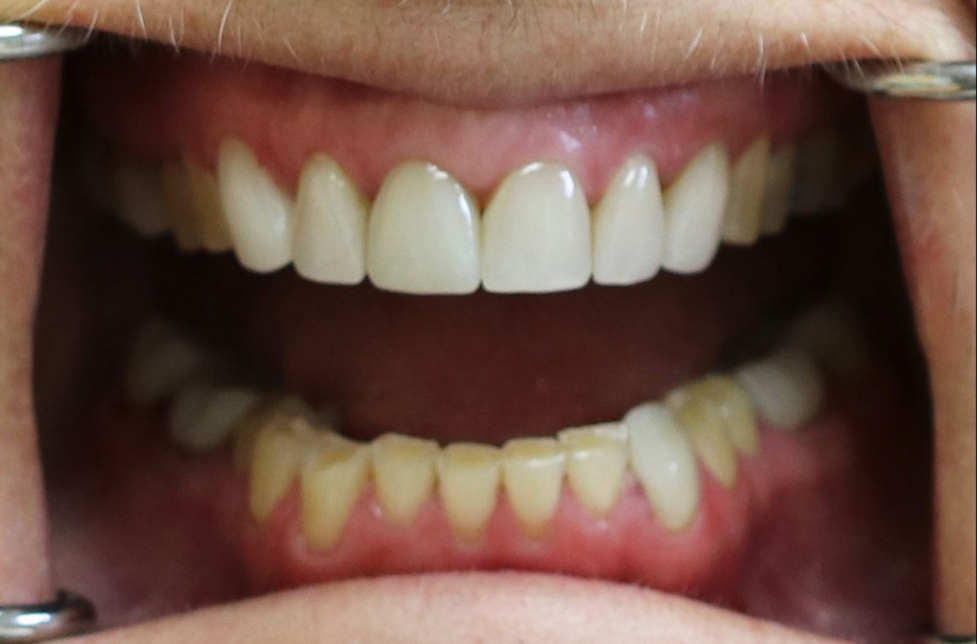 A close up of a person 's teeth with braces on them.