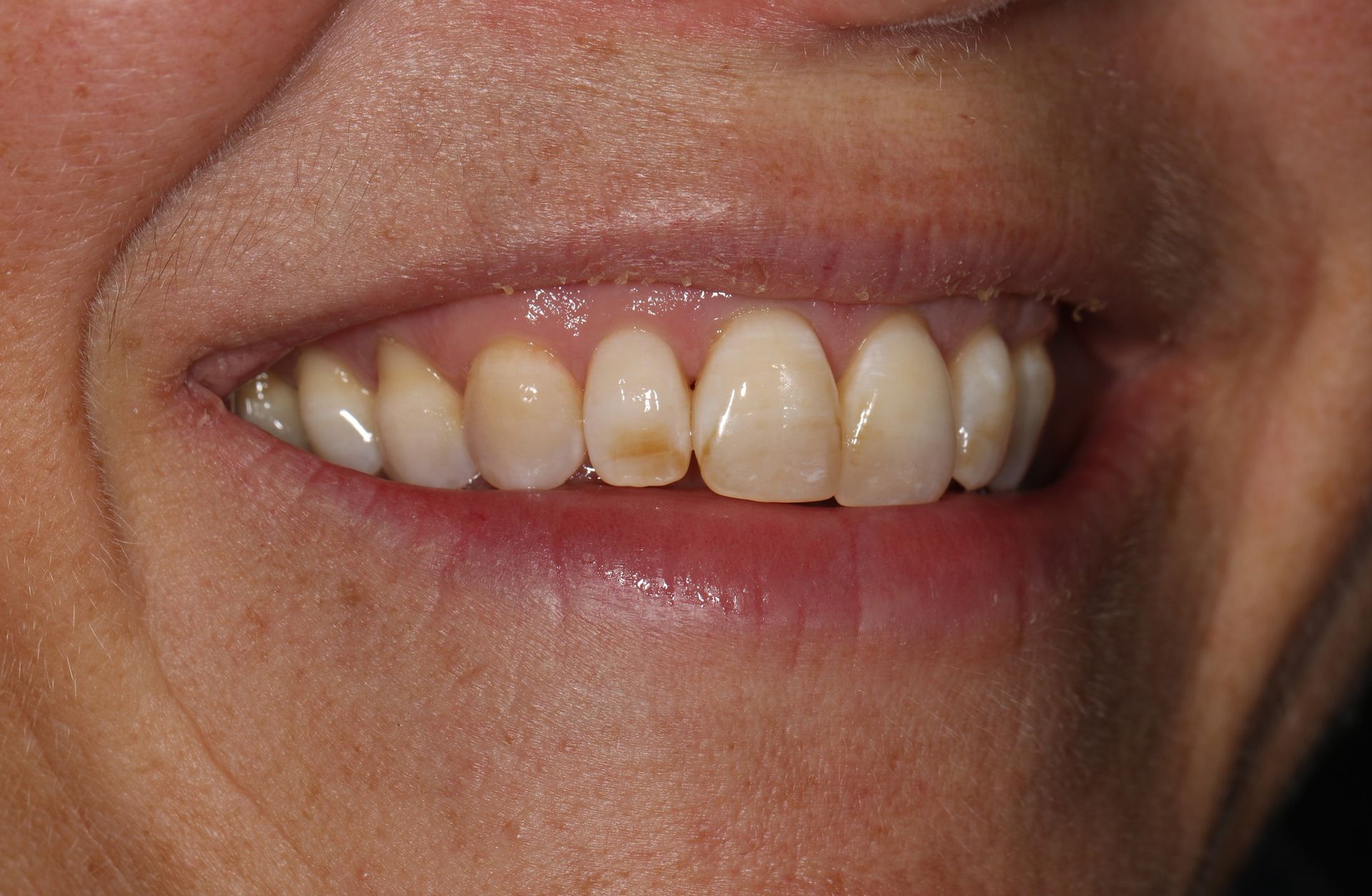 A close up of a woman 's teeth with a few brown spots on them.