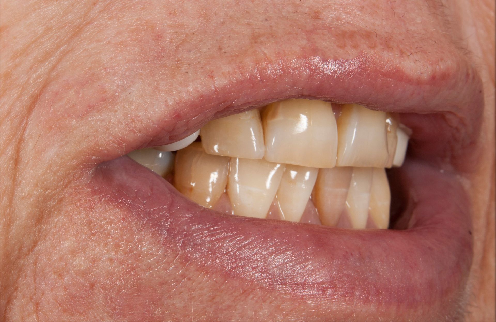 A close up of a person 's mouth with a lot of teeth.