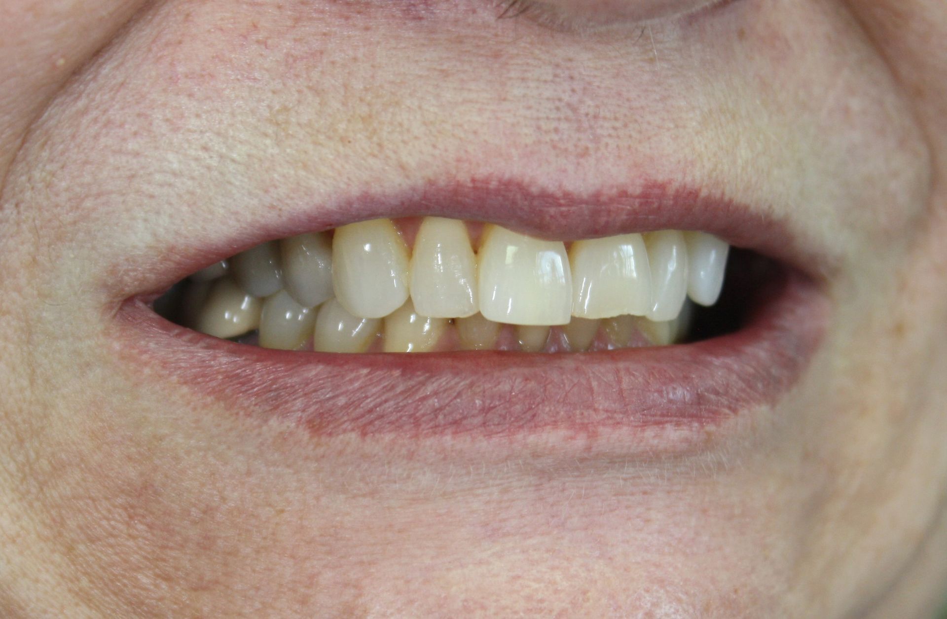 A close up of a woman 's mouth showing her teeth.