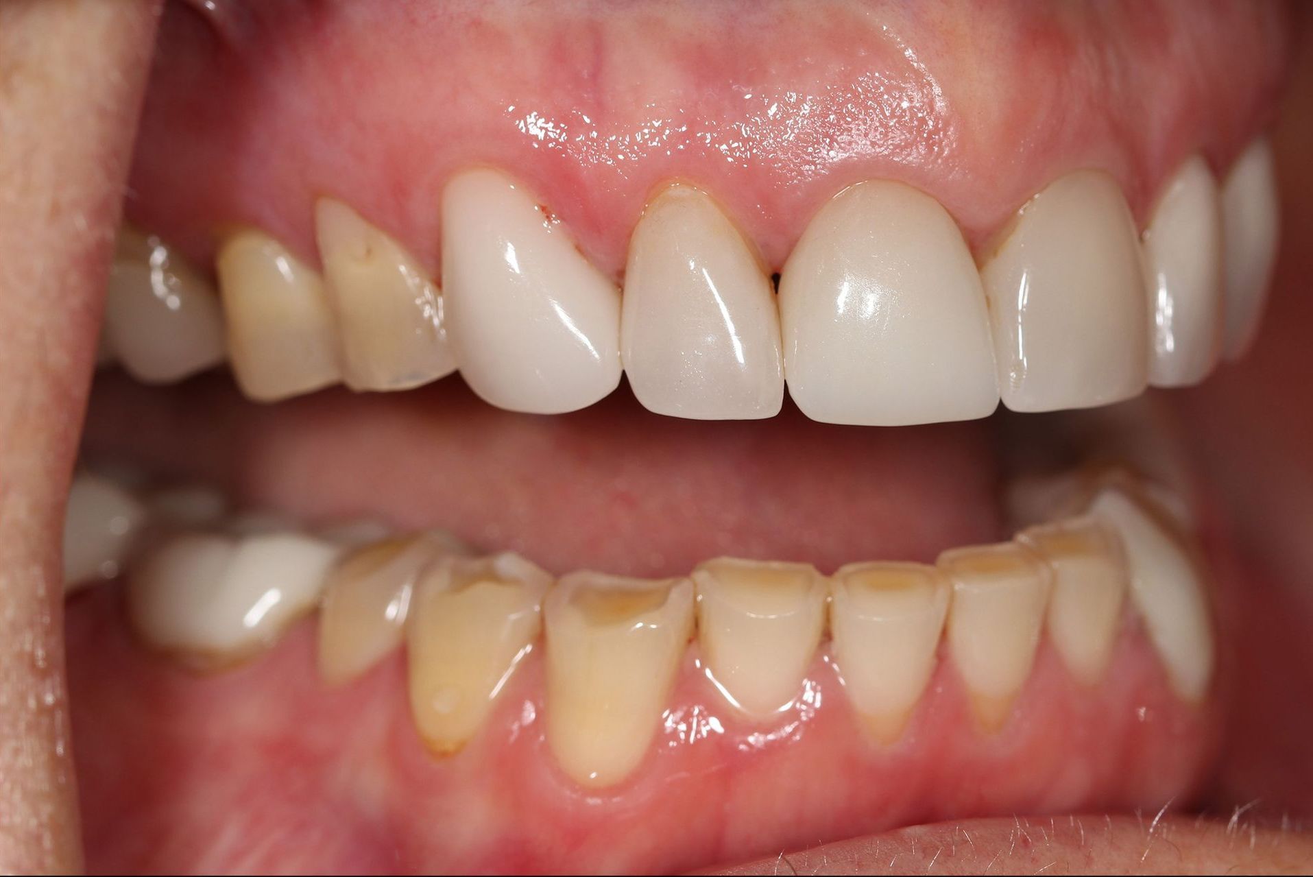 A close up of a person 's teeth with white teeth.