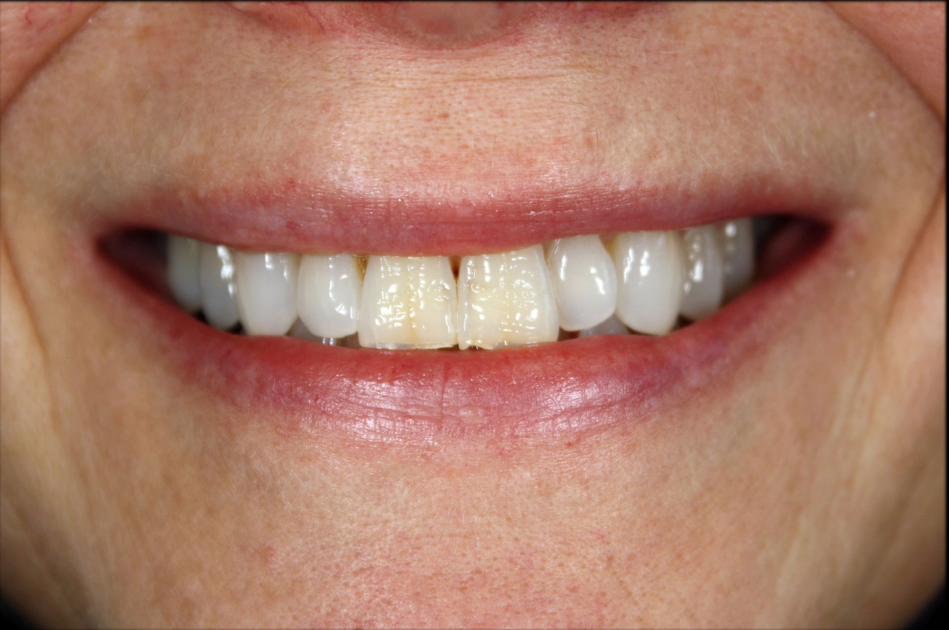 A close up of a woman 's smile with white teeth.