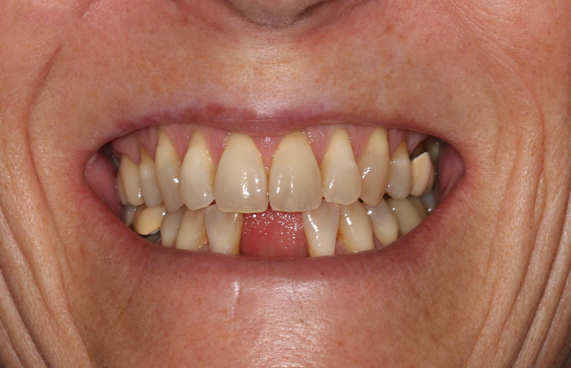 A close up of a person 's teeth with a missing tooth.