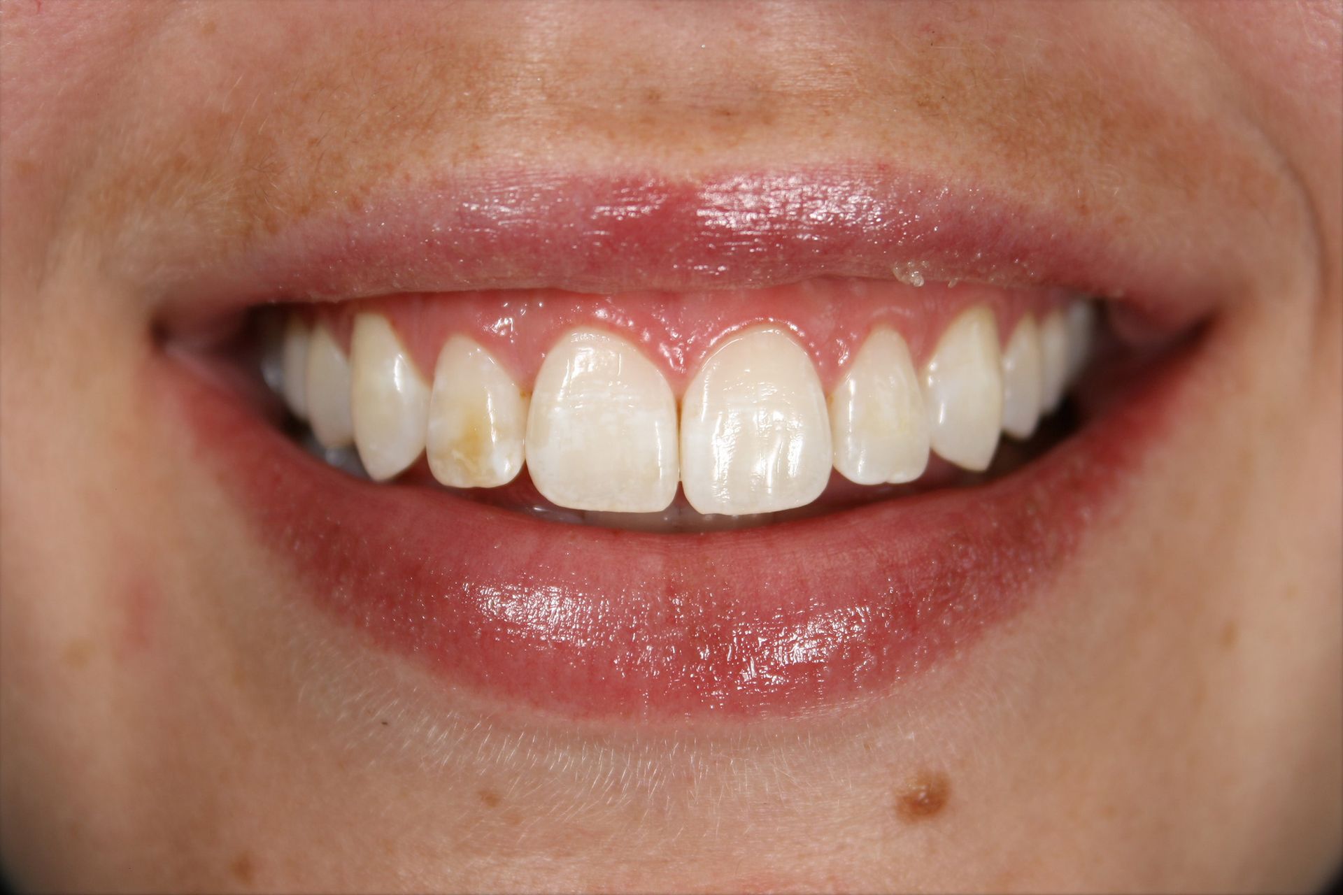 A close up of a woman 's smile with white teeth.
