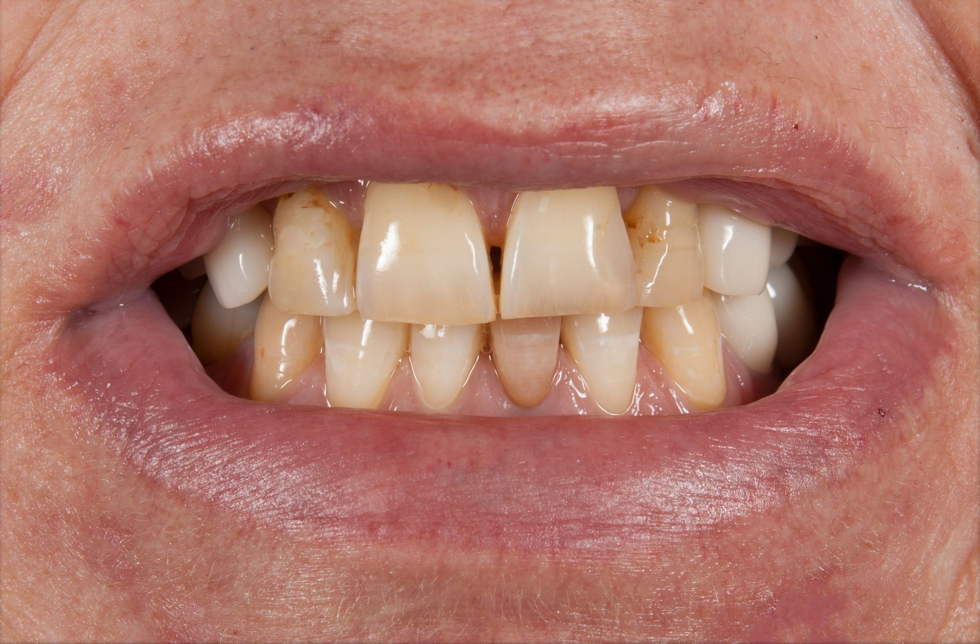 A close up of a person 's mouth showing their teeth.