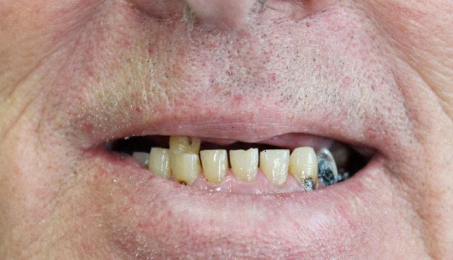 A close up of a man 's mouth with missing teeth.