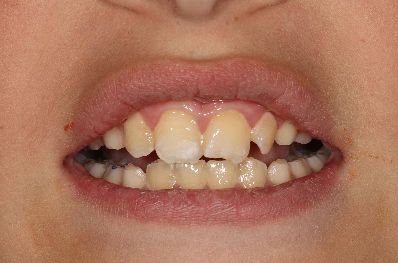 A close up of a person 's mouth with their teeth showing.