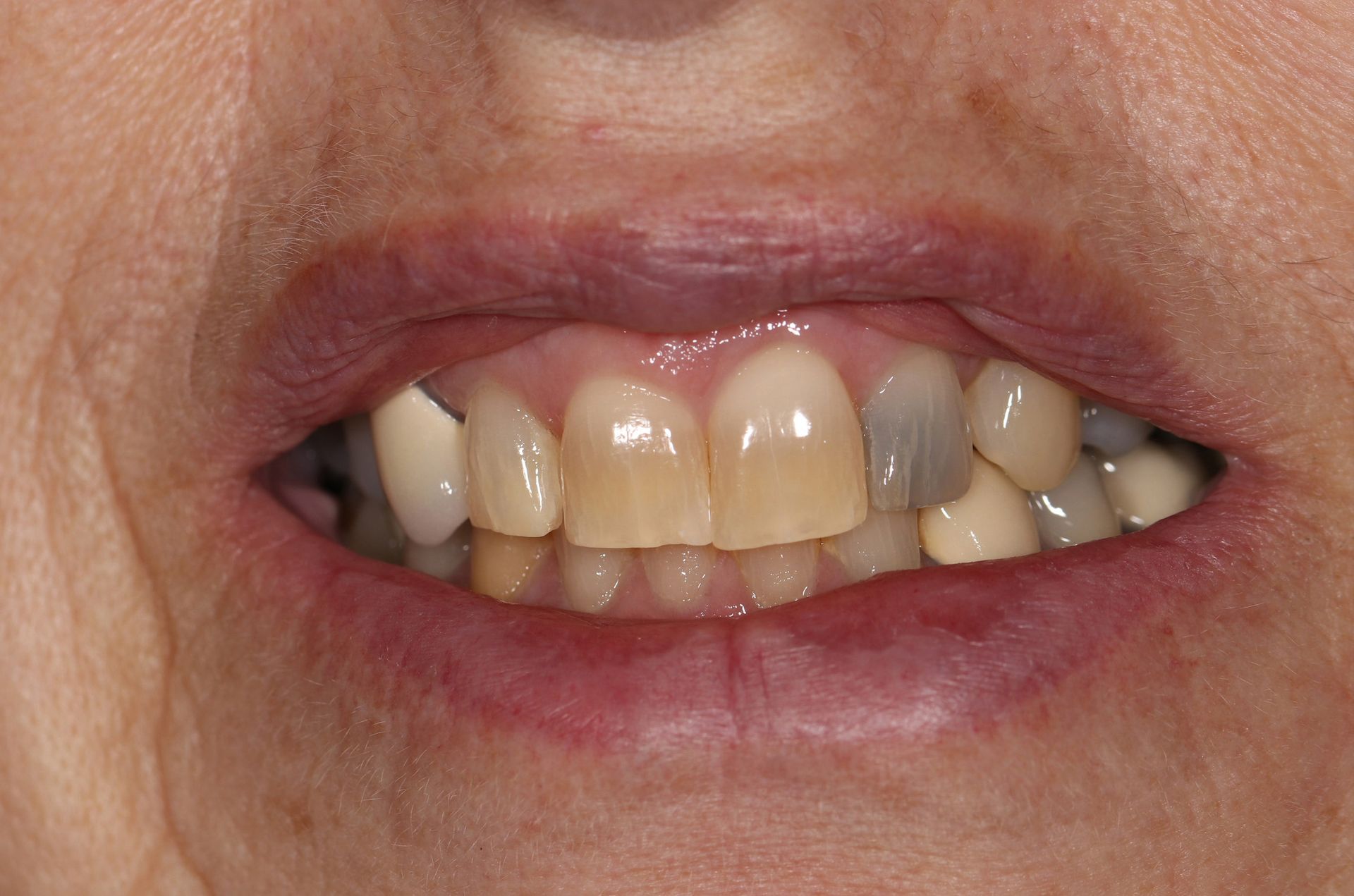 A close up of a woman 's mouth with a lot of teeth.
