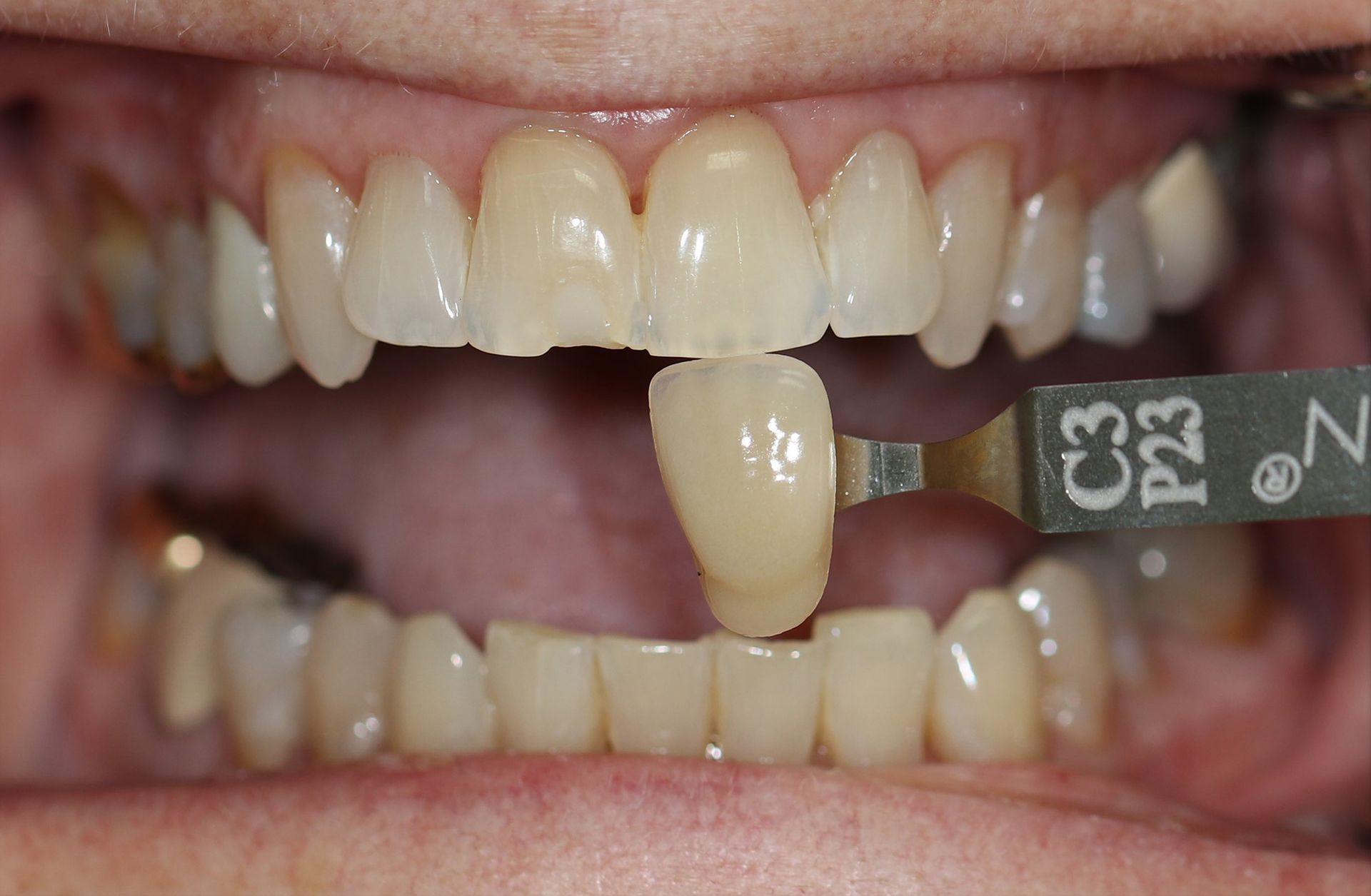 A close up of a person 's teeth with a tooth color chart.