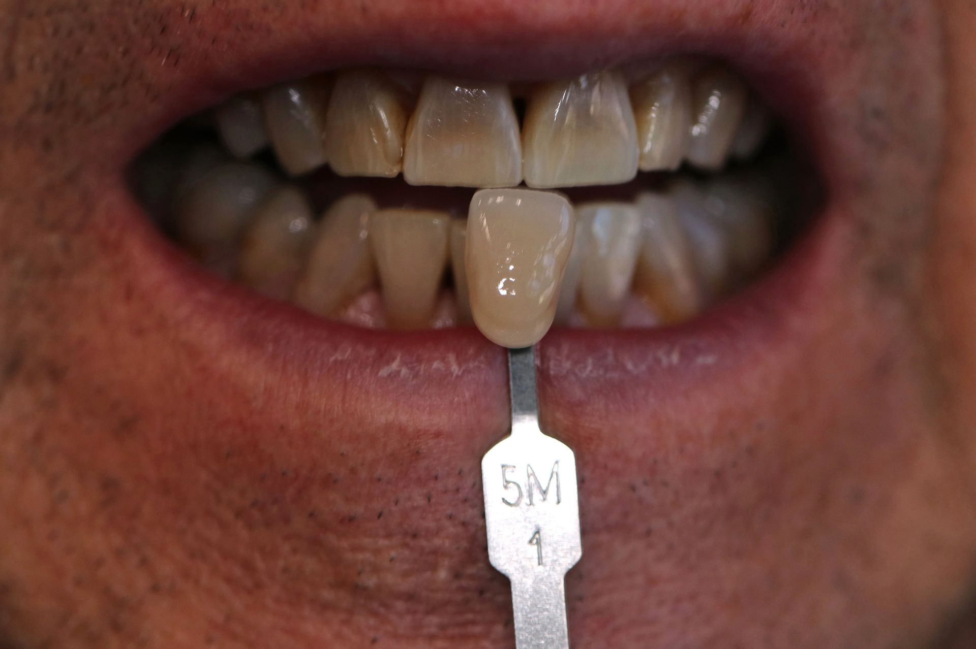 A close up of a man 's teeth with a tooth color chart in his mouth.