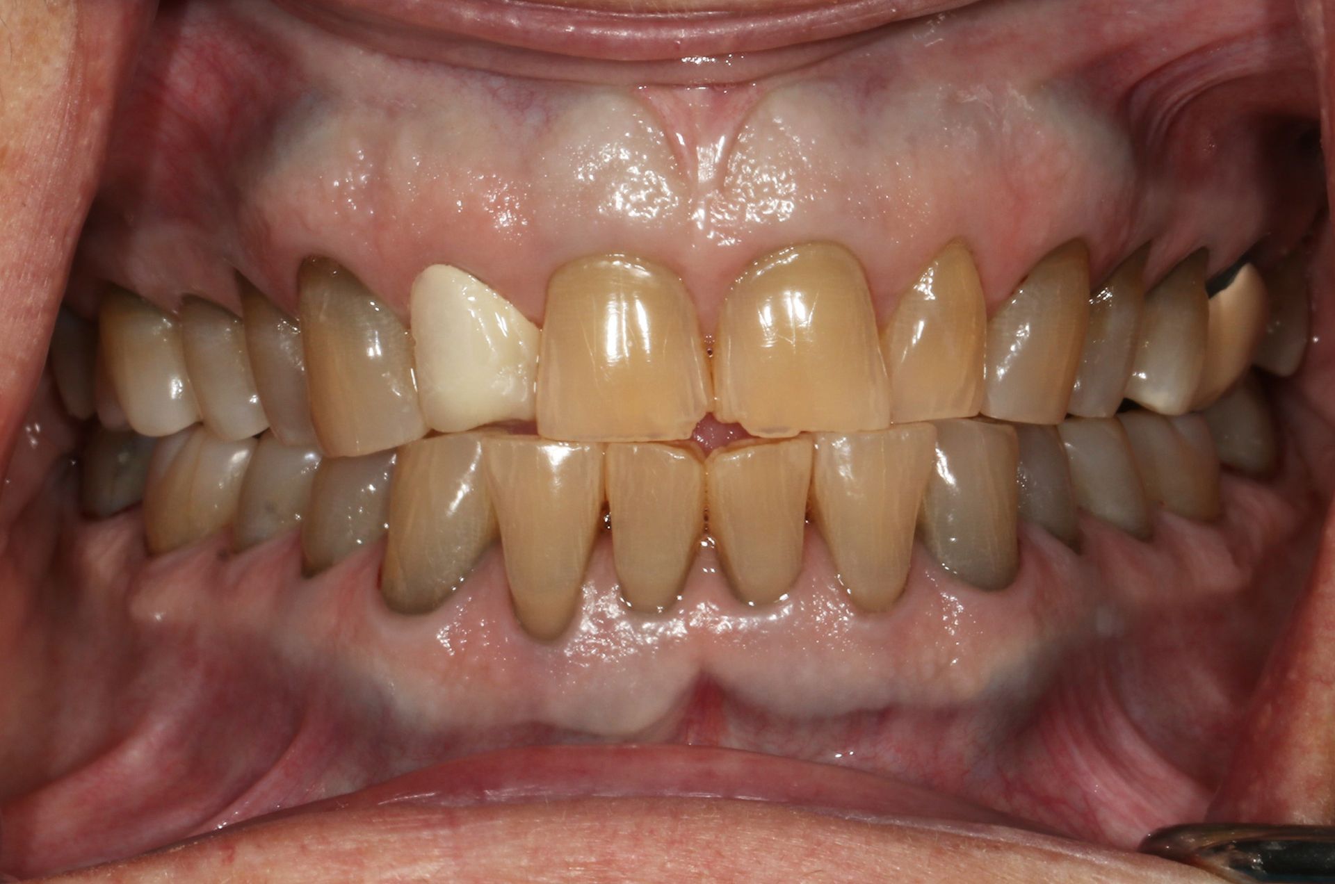 A close up of a person 's mouth with a lot of teeth.