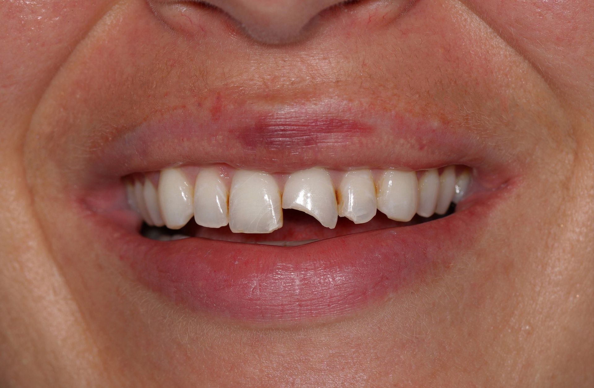 A close up of a woman 's mouth with a broken tooth.