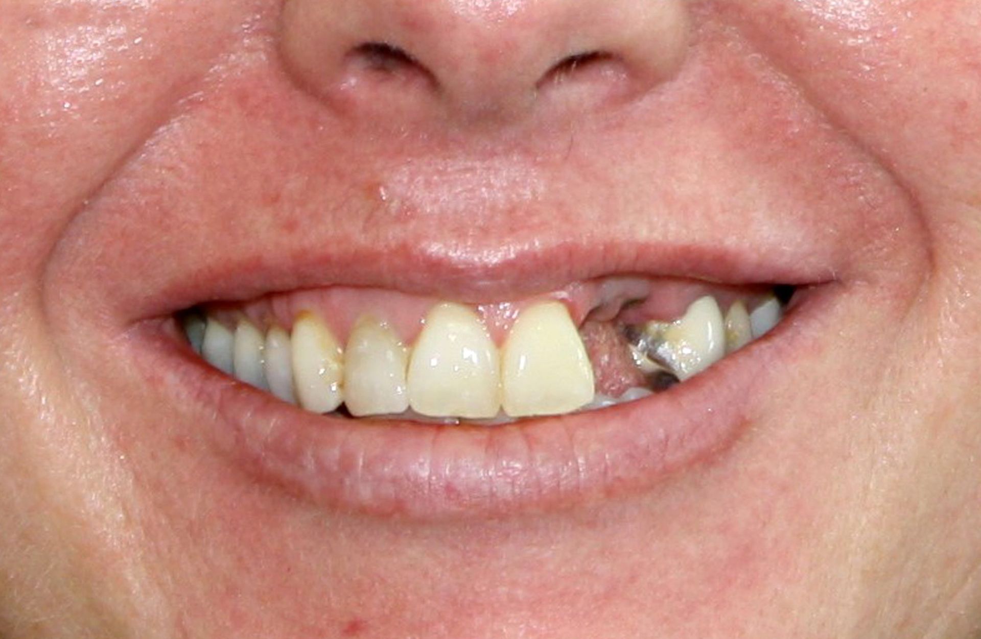 A close up of a woman 's mouth with missing teeth.