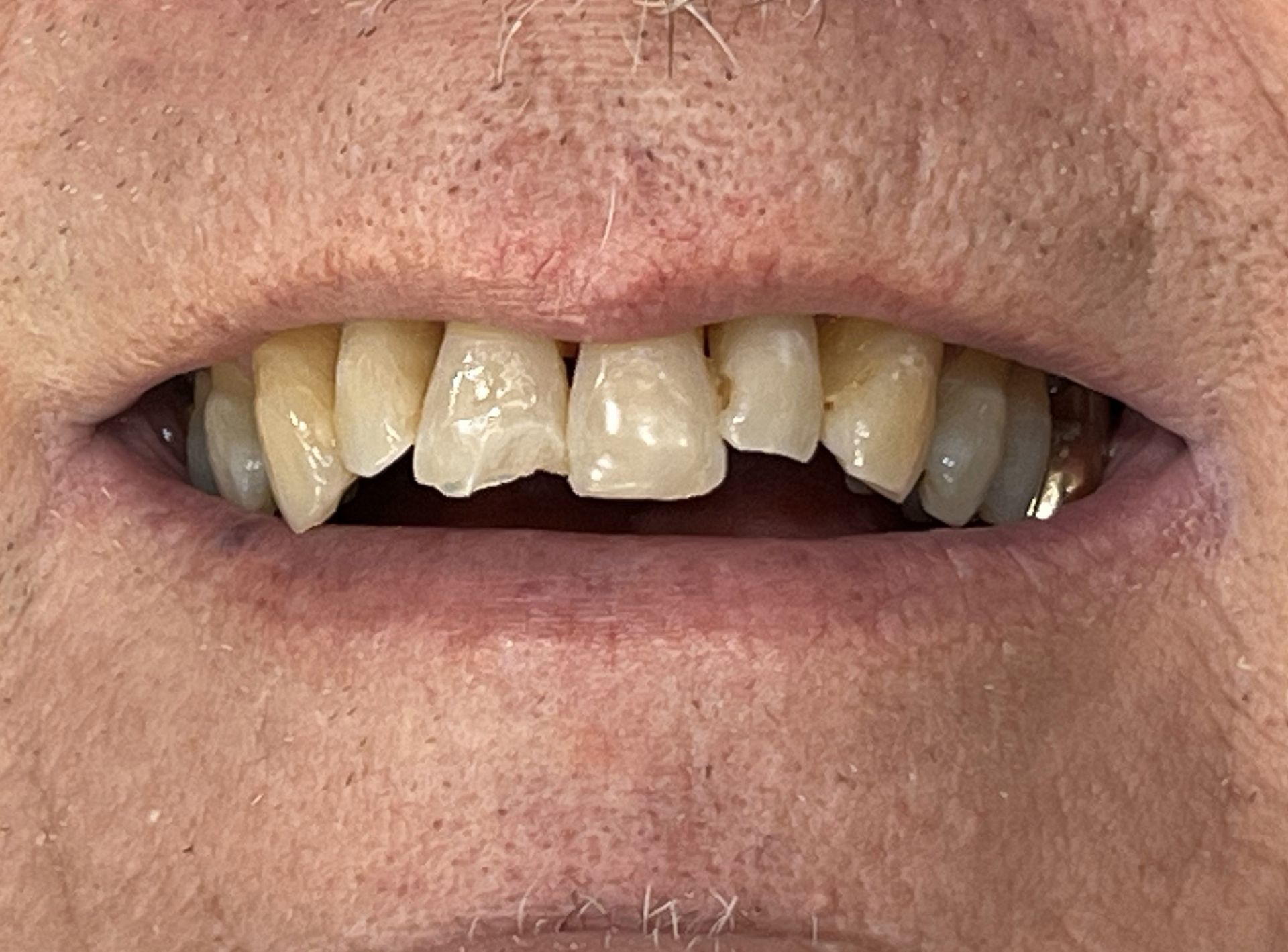 A close up of a man 's mouth with missing teeth.