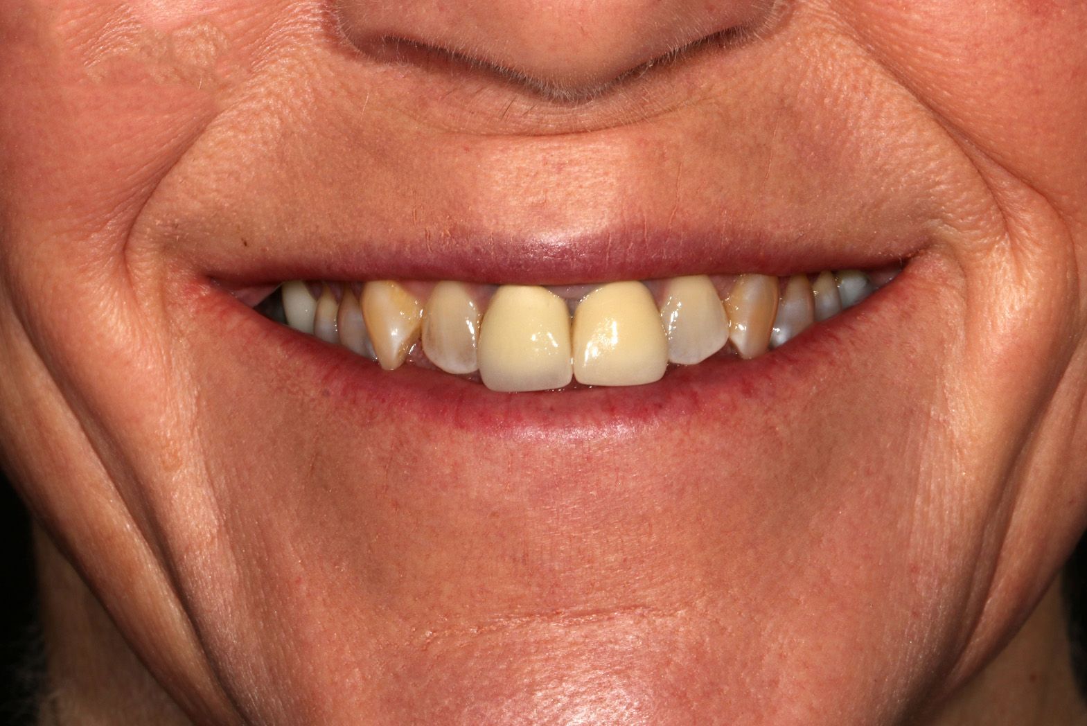 A close up of a woman 's smile with missing teeth.