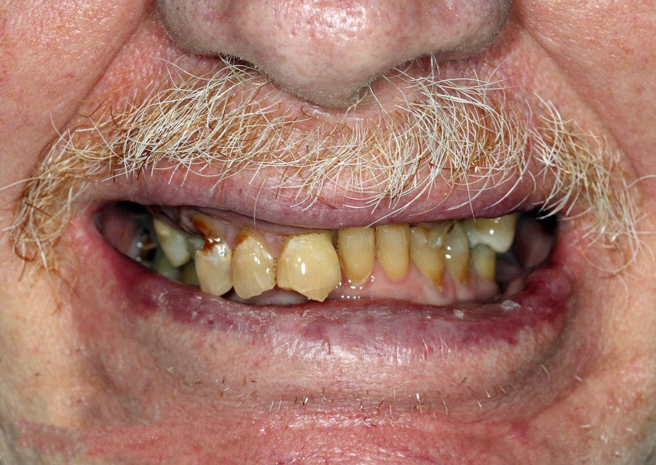 A close up of a man 's mouth with a beard and missing teeth.