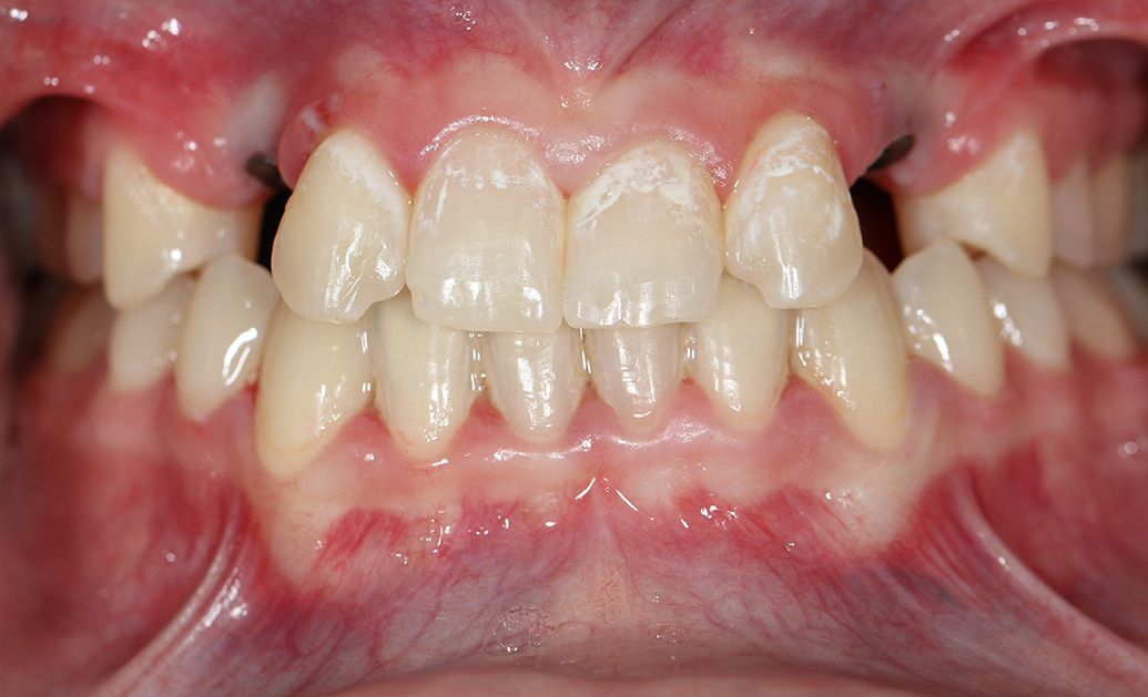 A close up of a person 's teeth and mouth.
