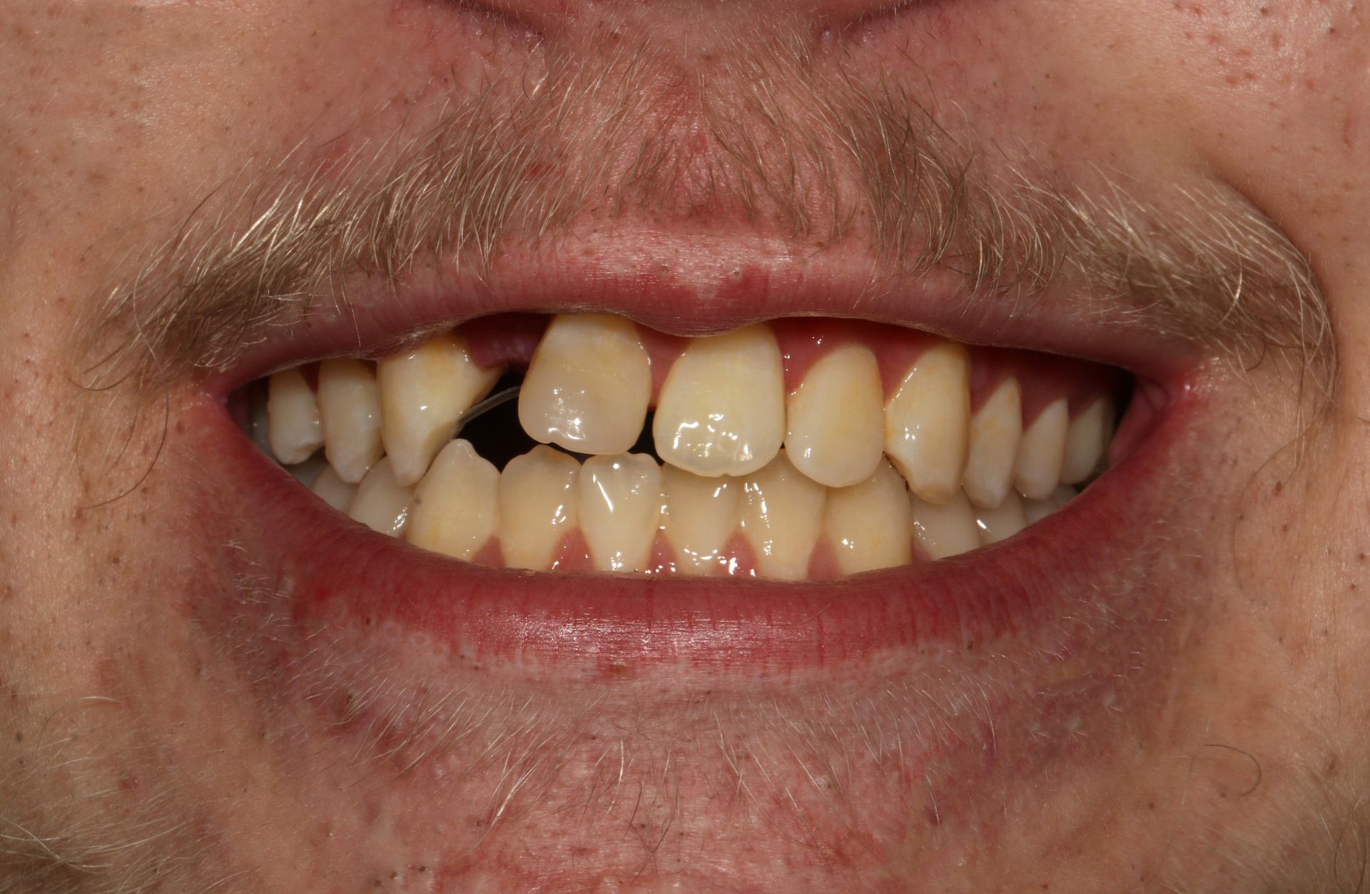 A close up of a man 's mouth with missing teeth.