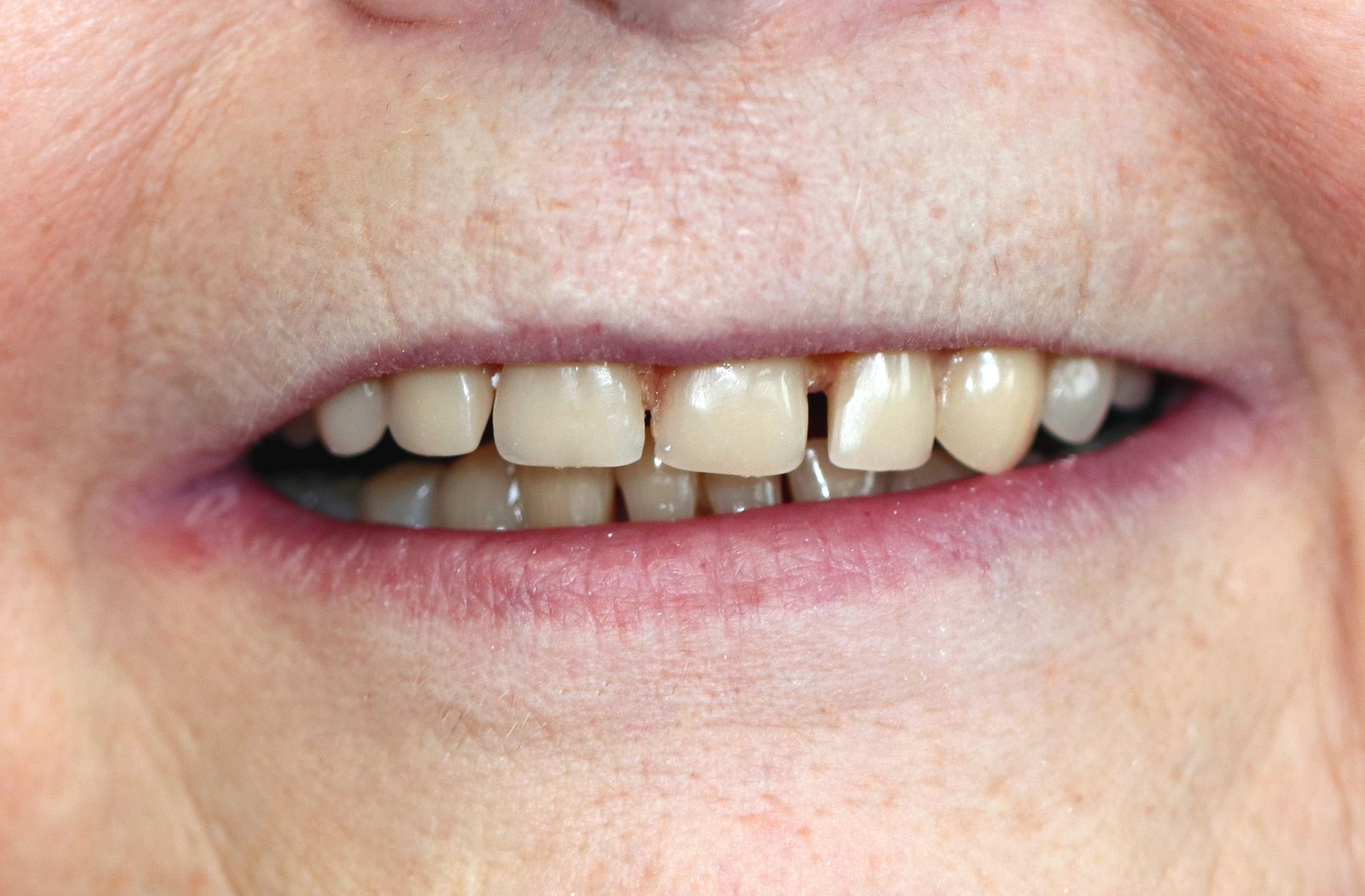 A close up of an elderly woman 's teeth and lips.