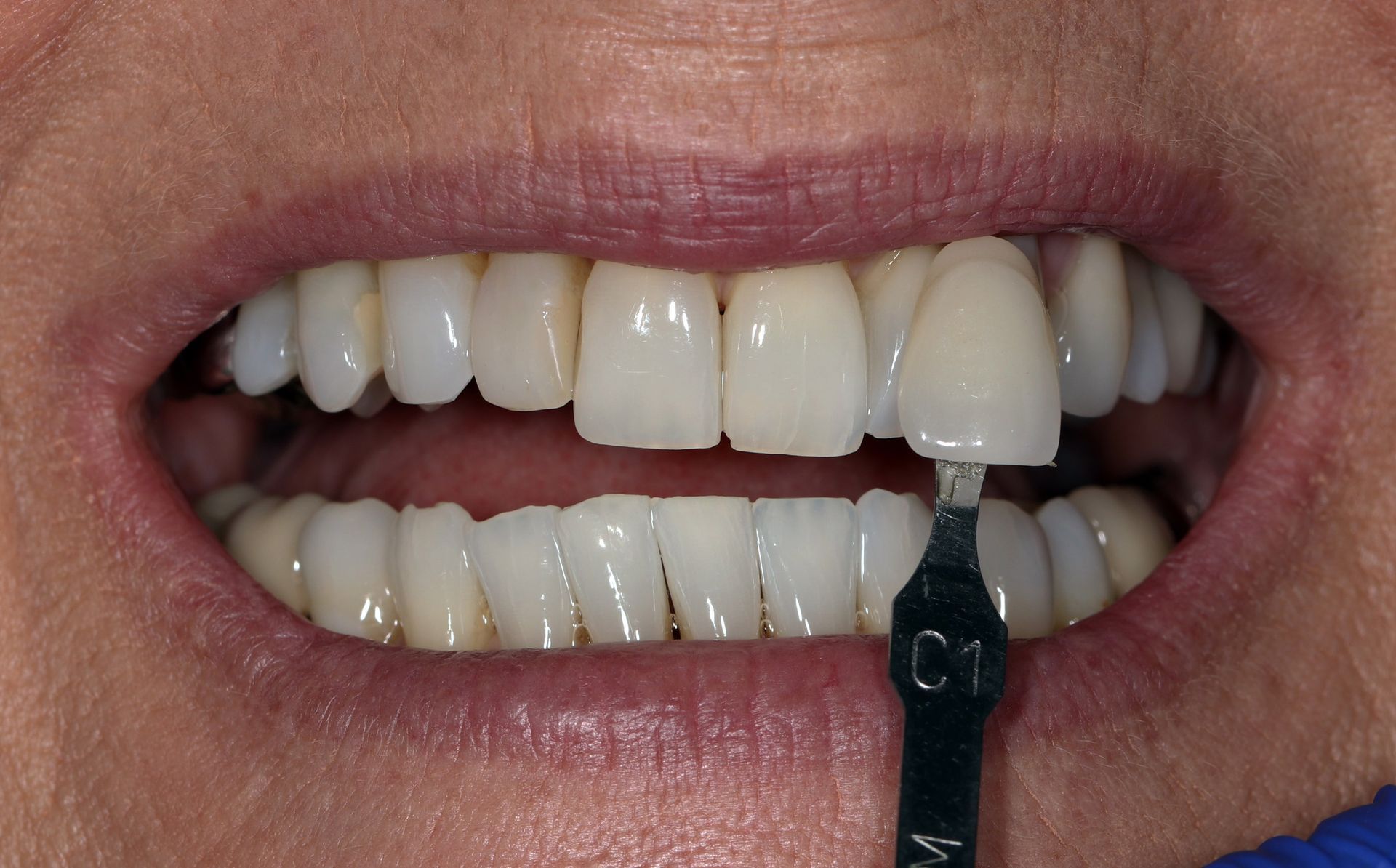 A close up of a person 's teeth with a toothbrush in their mouth.