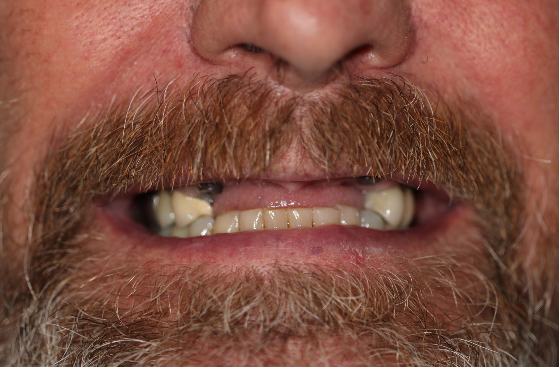 A close up of a man 's mouth with a beard and missing teeth.