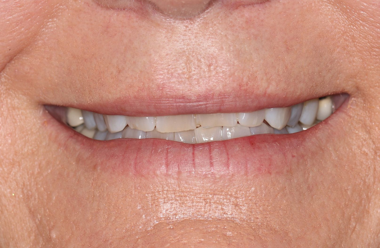A close up of a woman 's smile with missing teeth.