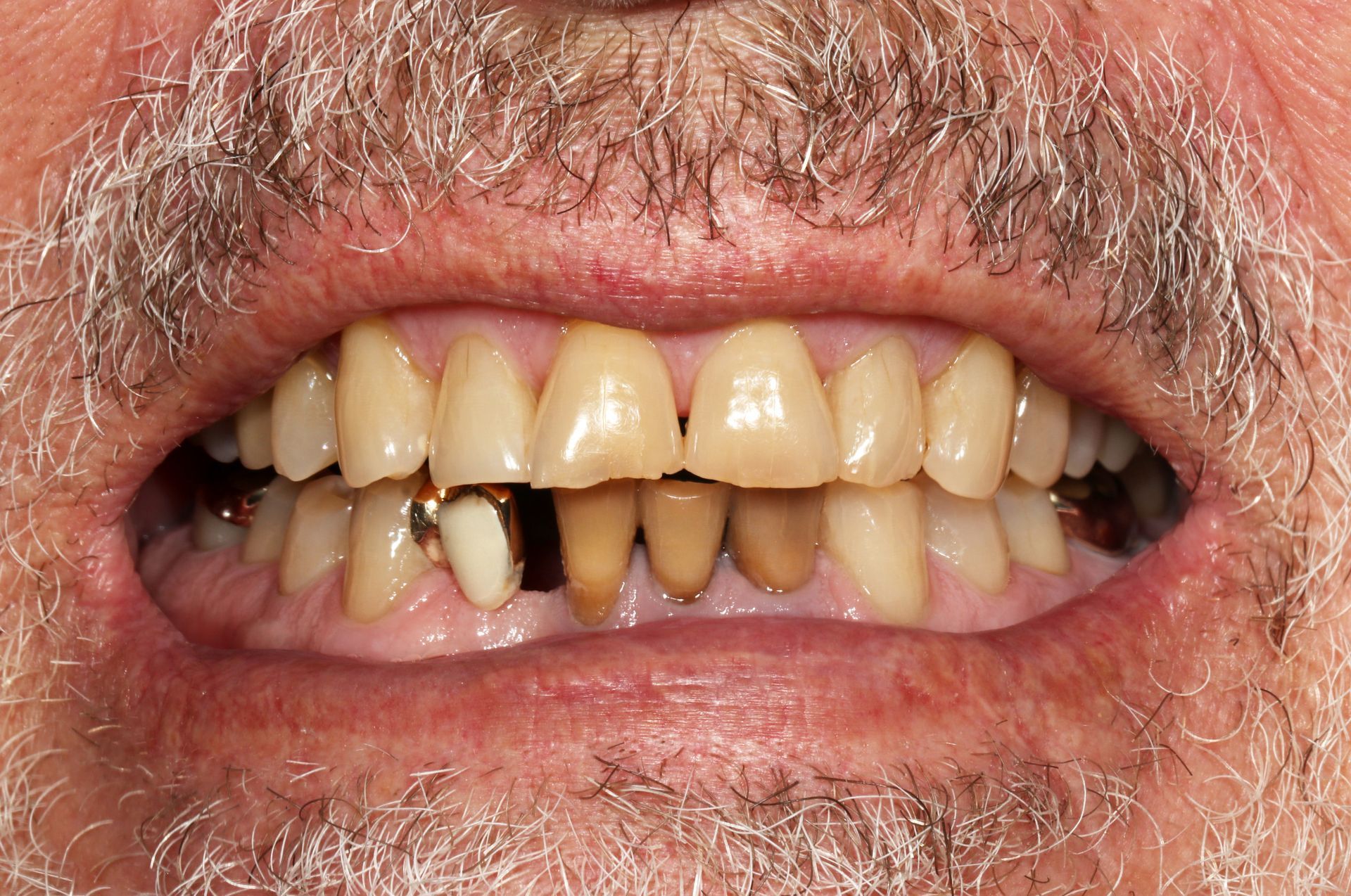 A close up of a man 's mouth with a beard and missing teeth.