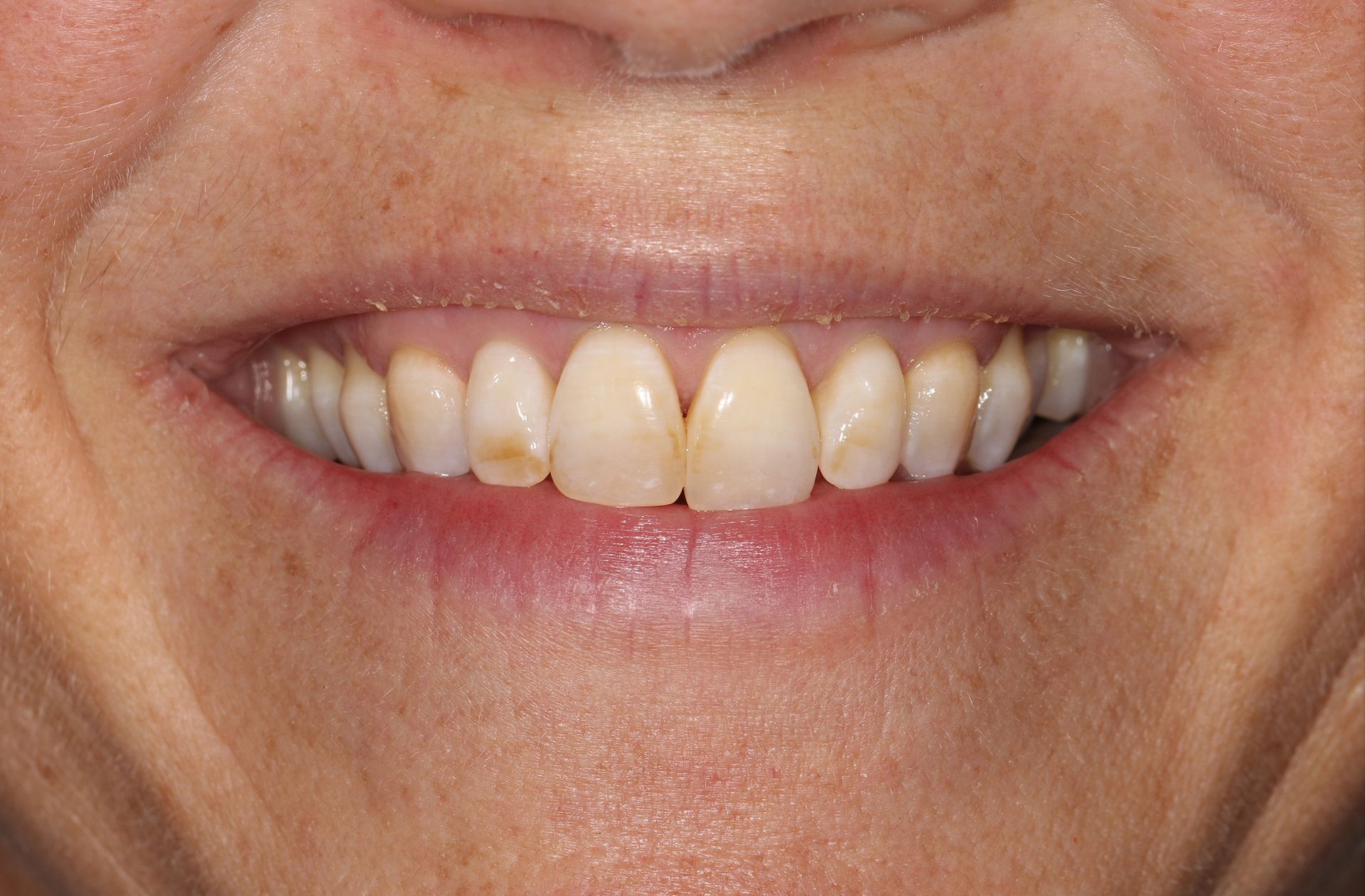 A close up of a woman 's smile with white teeth.