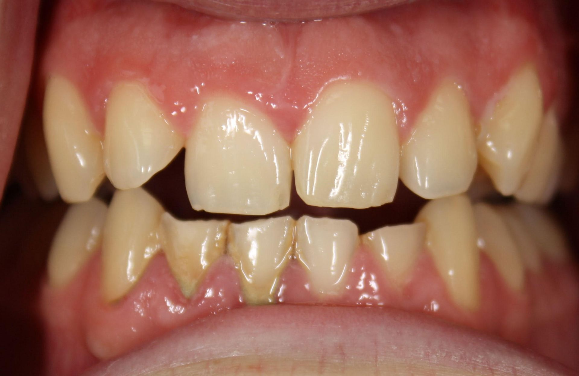 A close up of a person 's teeth with a broken tooth.