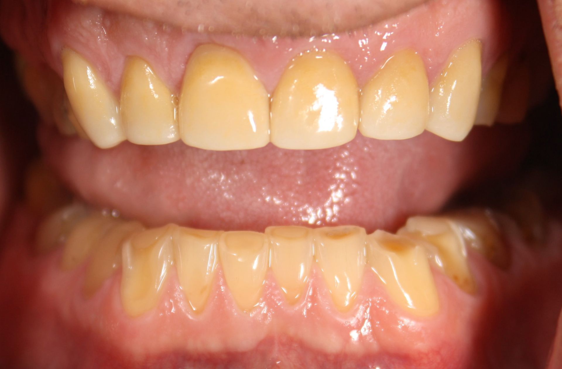 A close up of a person 's teeth with a broken tooth.