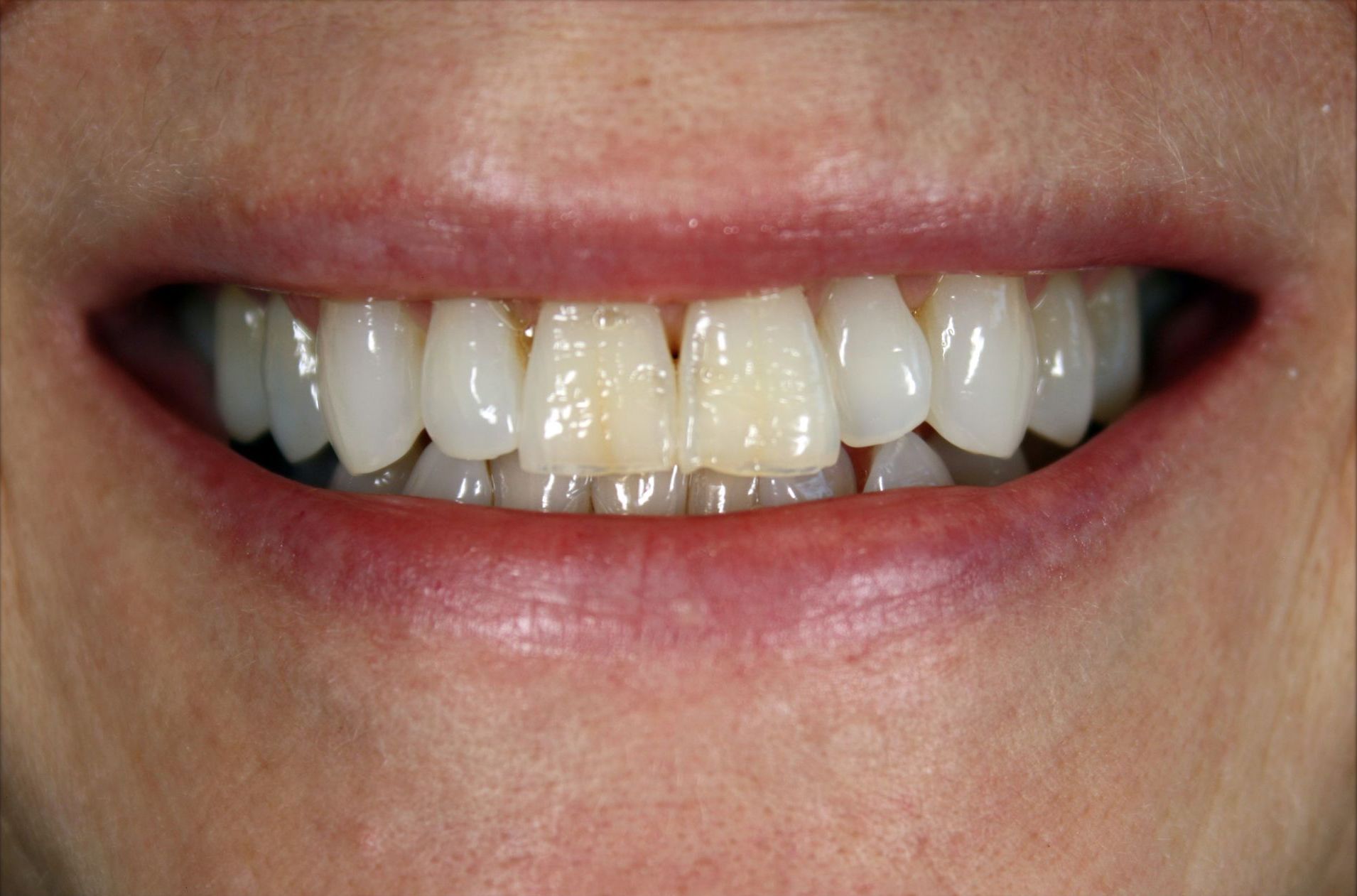 A close up of a person 's mouth with white teeth.