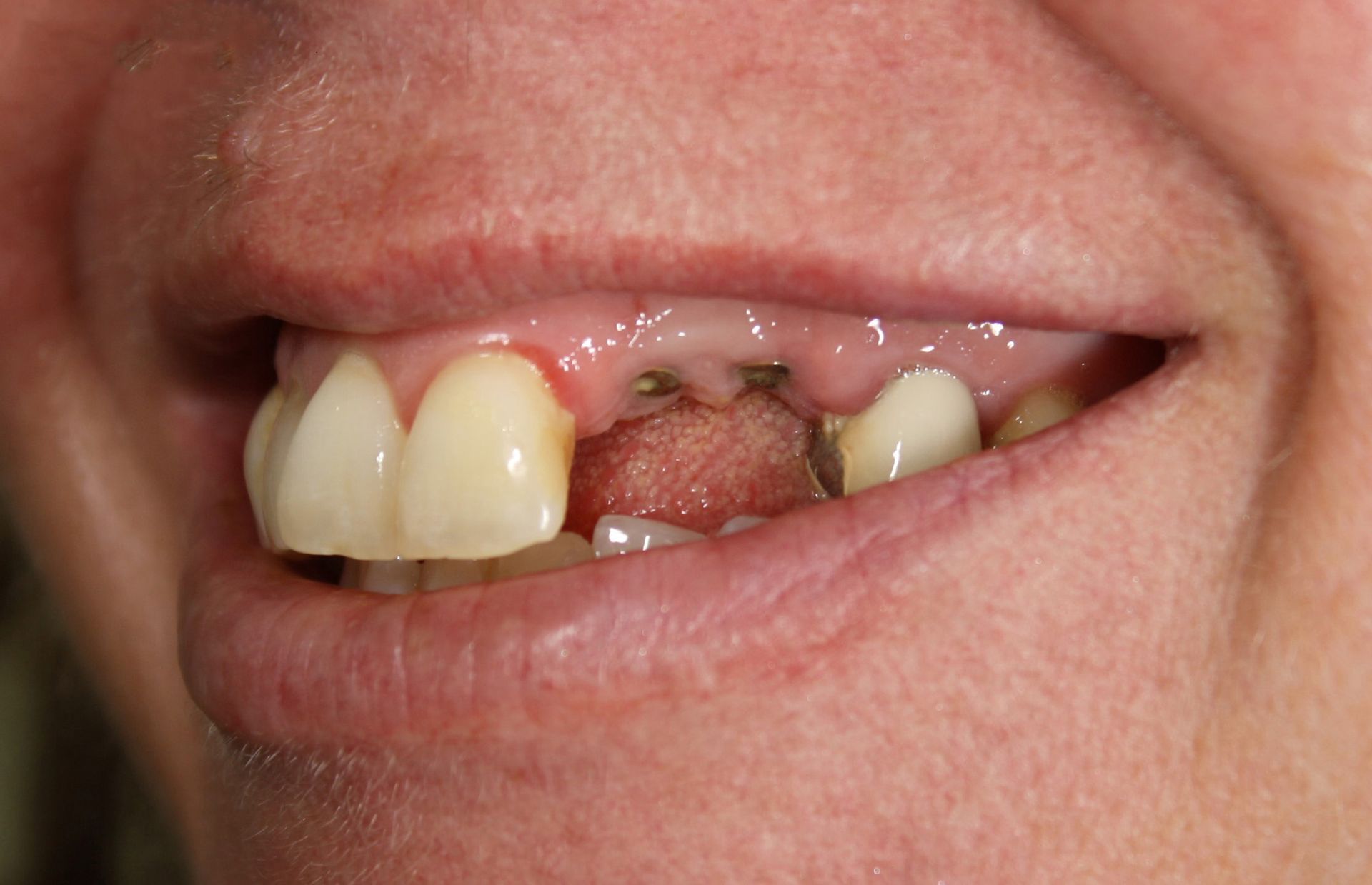 A close up of a person 's mouth with missing teeth.