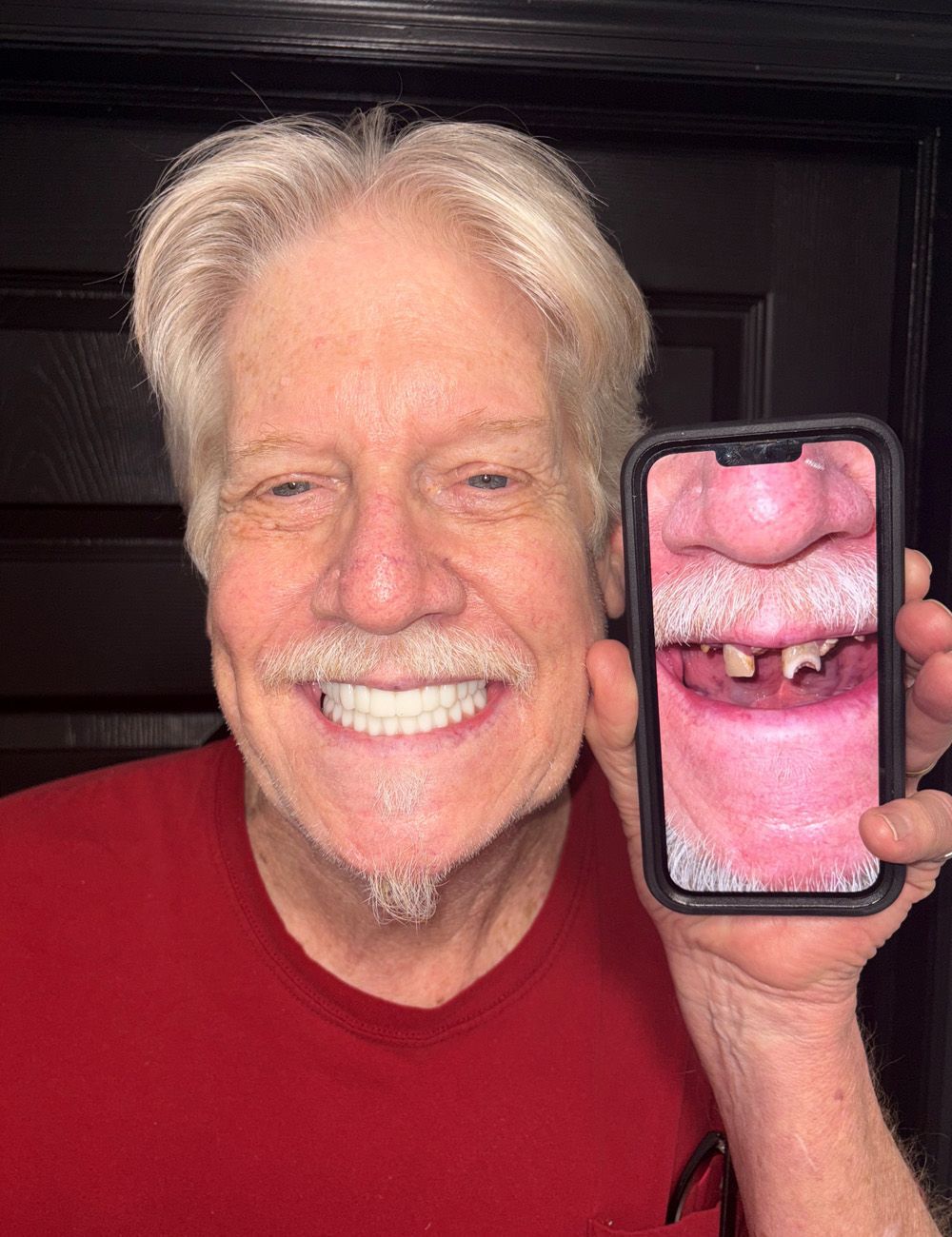 Man with new teeth smiles, holding phone displaying his old teeth. Red shirt.