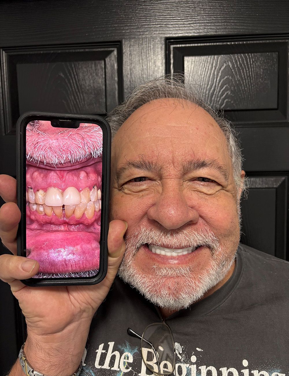 Man smiling, holding phone showing close-up of teeth. Dark background.