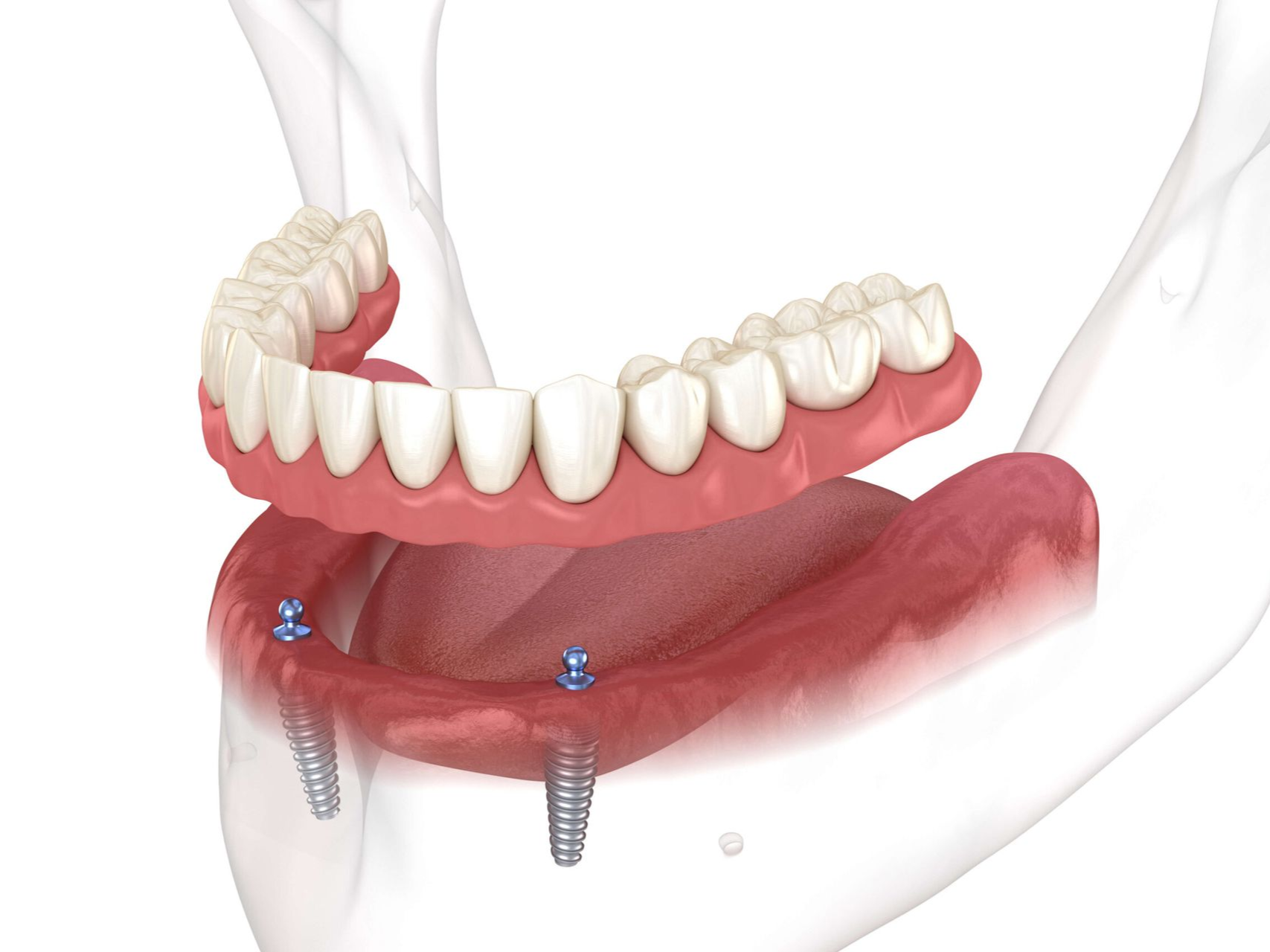 Illustration of dentures secured by implants in a jawbone. White teeth set in pink gum, with silver implant posts.